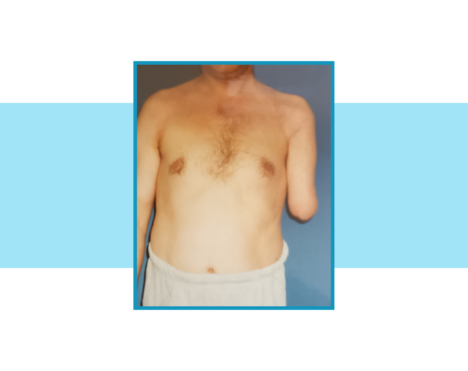 Zdjęcie człowieka z długim kikutem lewego ramienia.