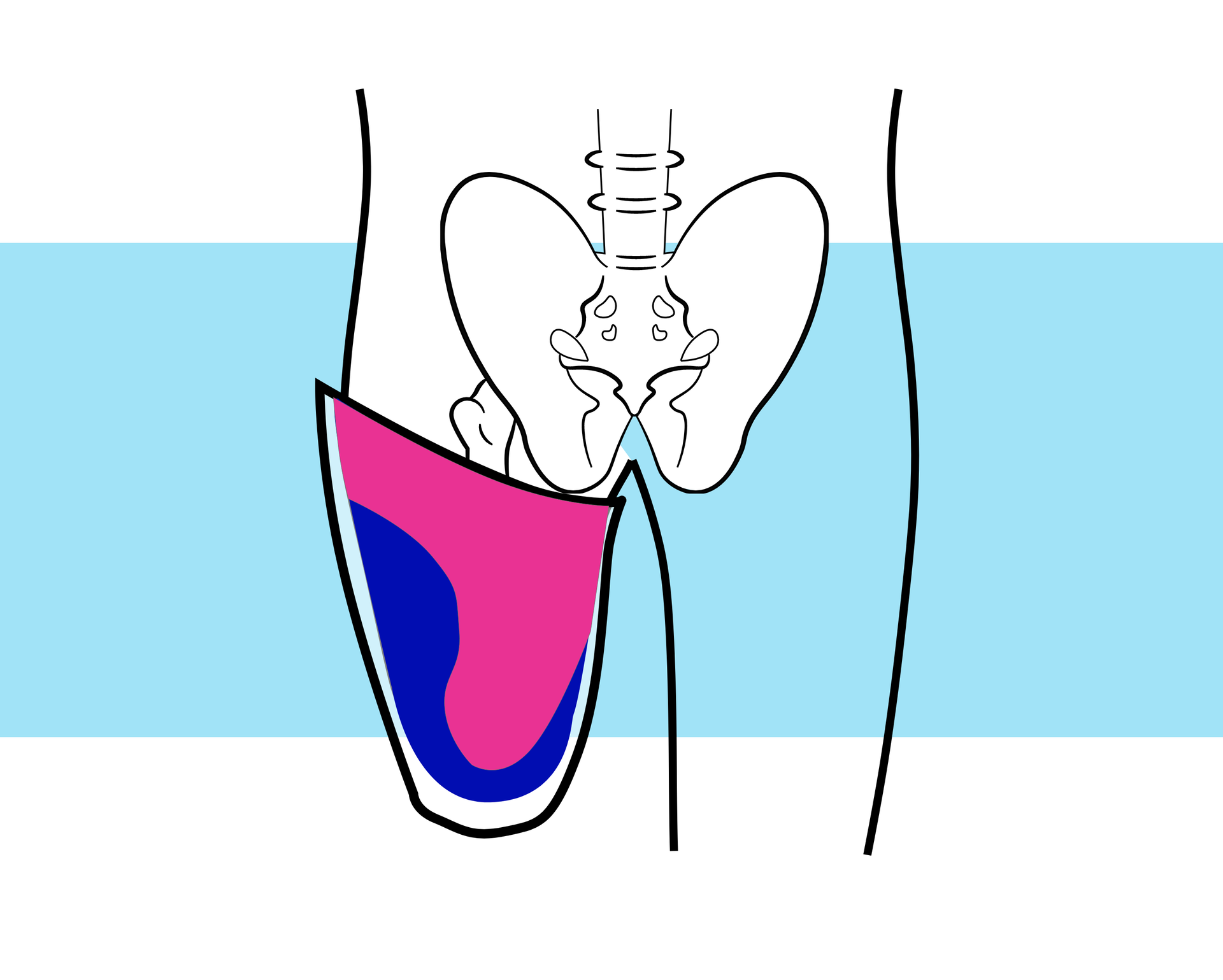 Grafika przedstawia schemat kończyn dolnych wraz ze szkieletem. Jedna z kończyn to kikut. Na rycinie zaprezentowano ukształtowanie ściany tylnej leja czworobocznego. Po jego bocznej stronie widać wypukłość.