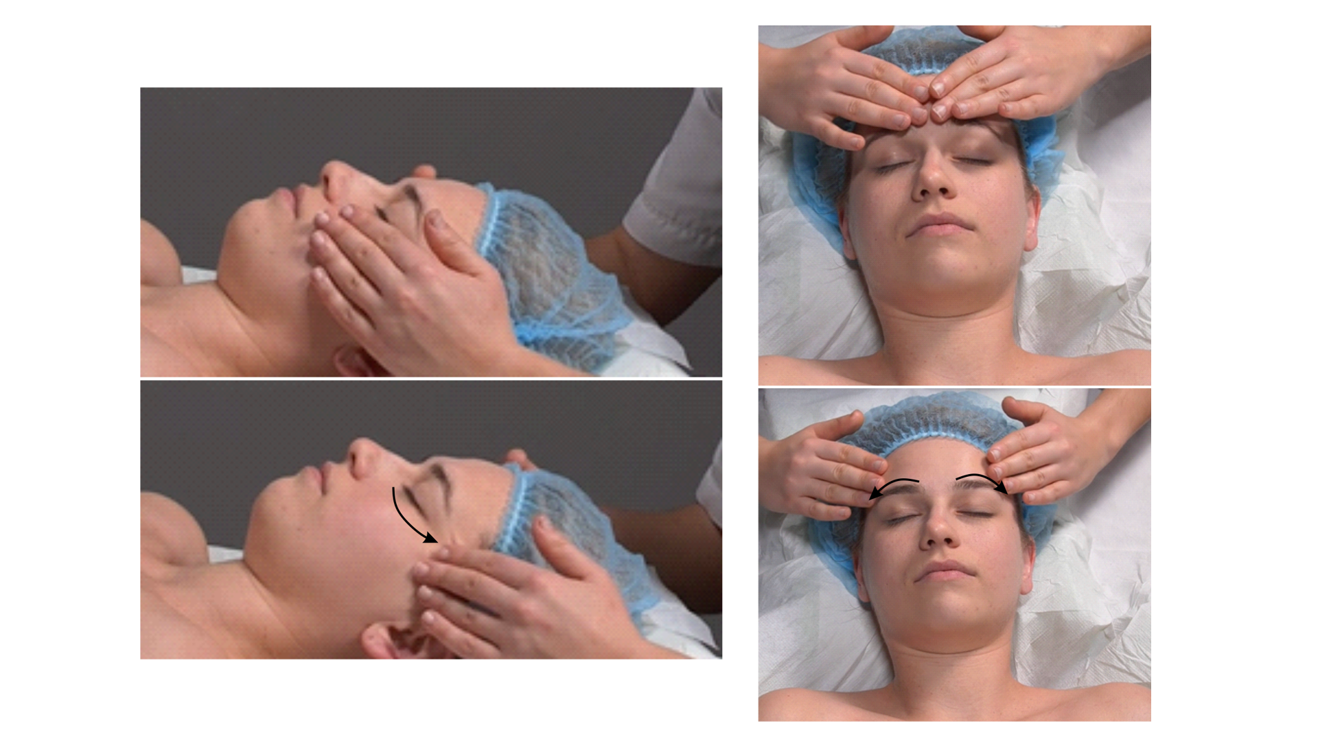 Zdjęcie przedstawia twarz pacjenta w leżeniu tyłem. Głowa pacjenta spoczywa na poduszce. Masażysta znajduje się za głową pacjenta i wykonuje ruch głaskania opuszkami palca wskazującego i długiego pod oczami rozpoczynając od okolicy wewnętrznego kącika i kierując się w stronę zewnętrzną. Następnie masażysta wykonuje ruch głaskania opuszkami palców wzdłuż łuków brwiowych rozpoczynając od ich części przyśrodkowej kierując się następnie na zewnątrz. 