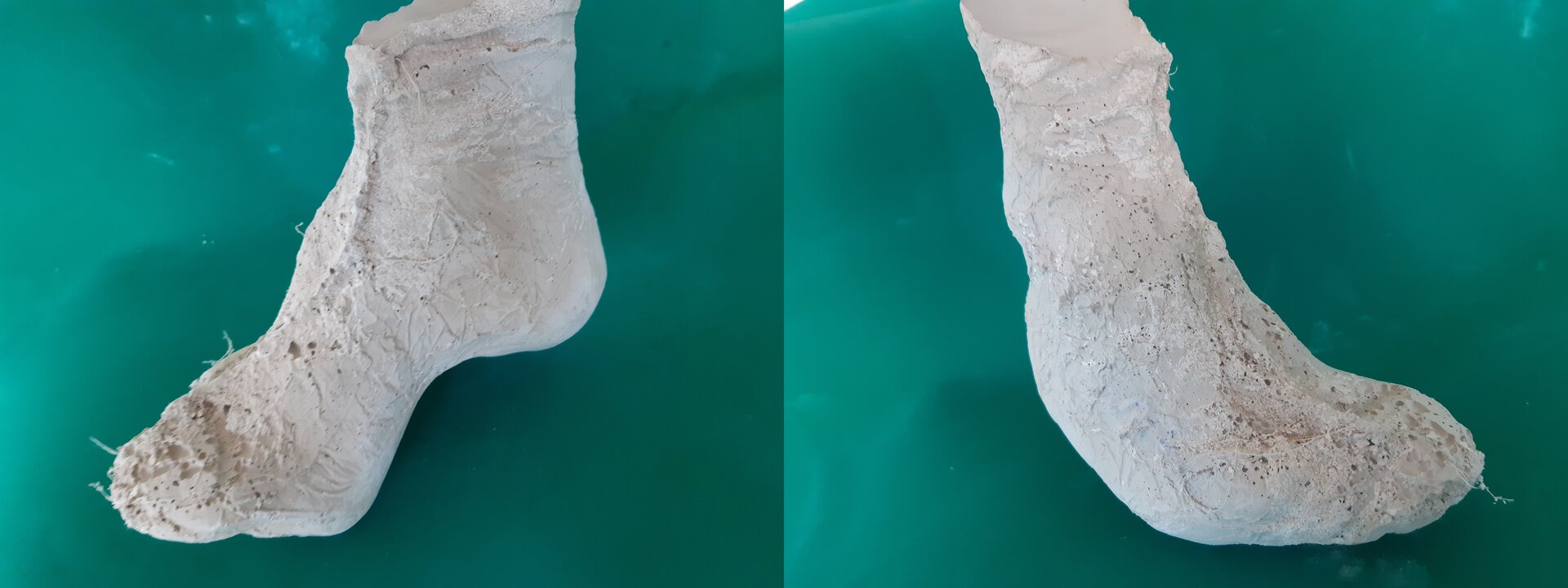 Zdjęcie przedstawia odlewy gipsowe stóp końsko szpotawych.