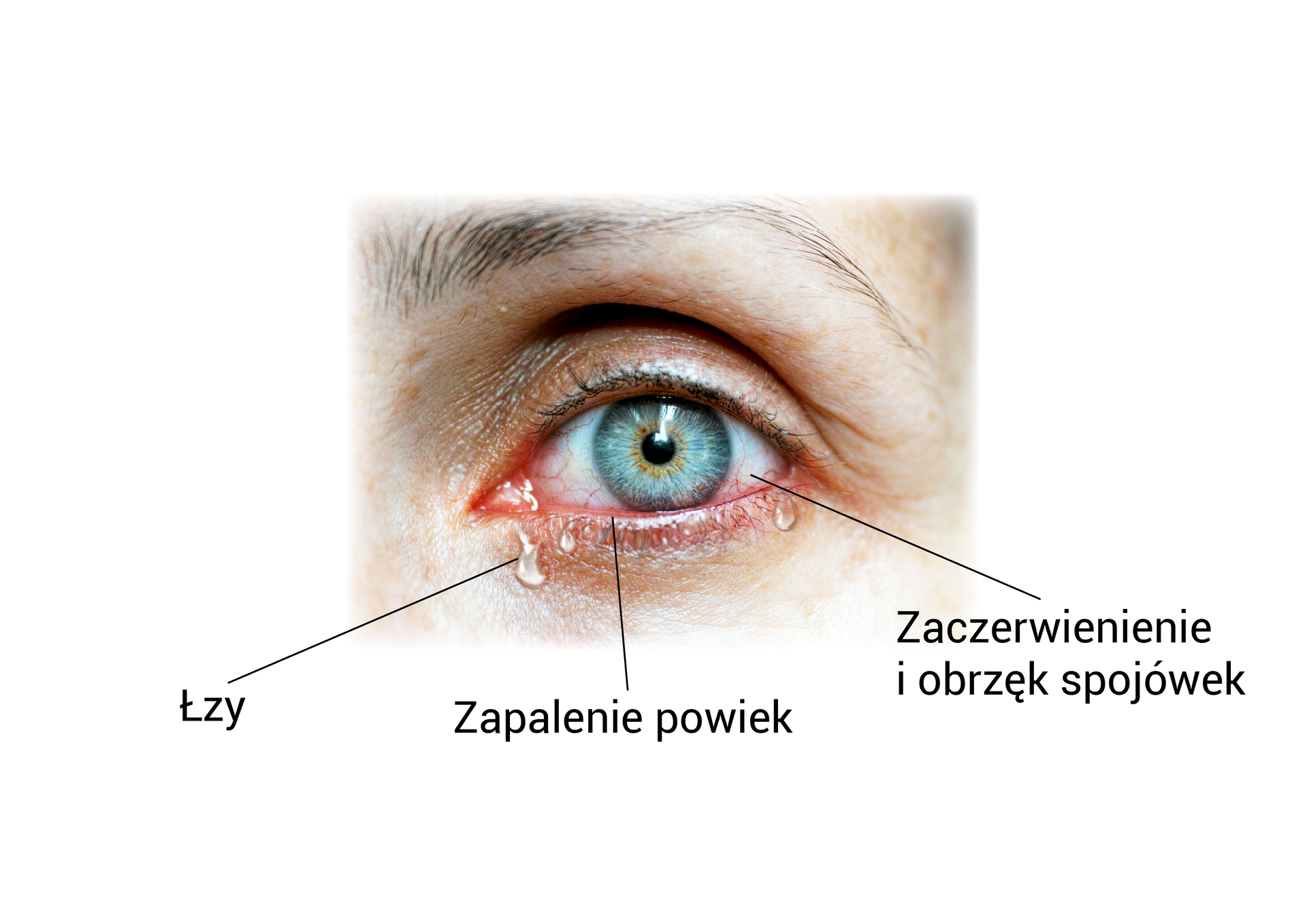 Zdjęcie przedstawia zbliżenie na oko, na którym zaznaczono łzy, zapalenie powiek (zaczerwienione powieki) oraz zaczerwienienie i obrzęk spojówek.