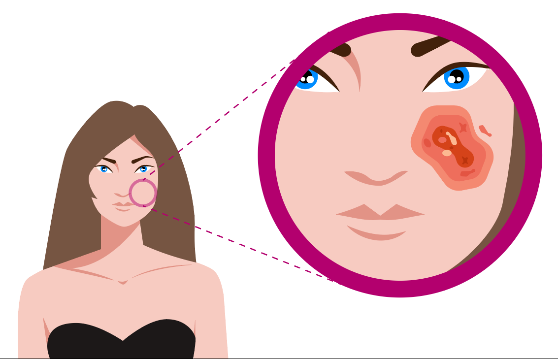 Grafika przedstawia kobietę wraz ze zbliżeniem na twarz. Na skórze twarzy obok nosa i pod okiem widoczne zaczerwienione miejsce będące efektem poparzenia elektrolitycznego.