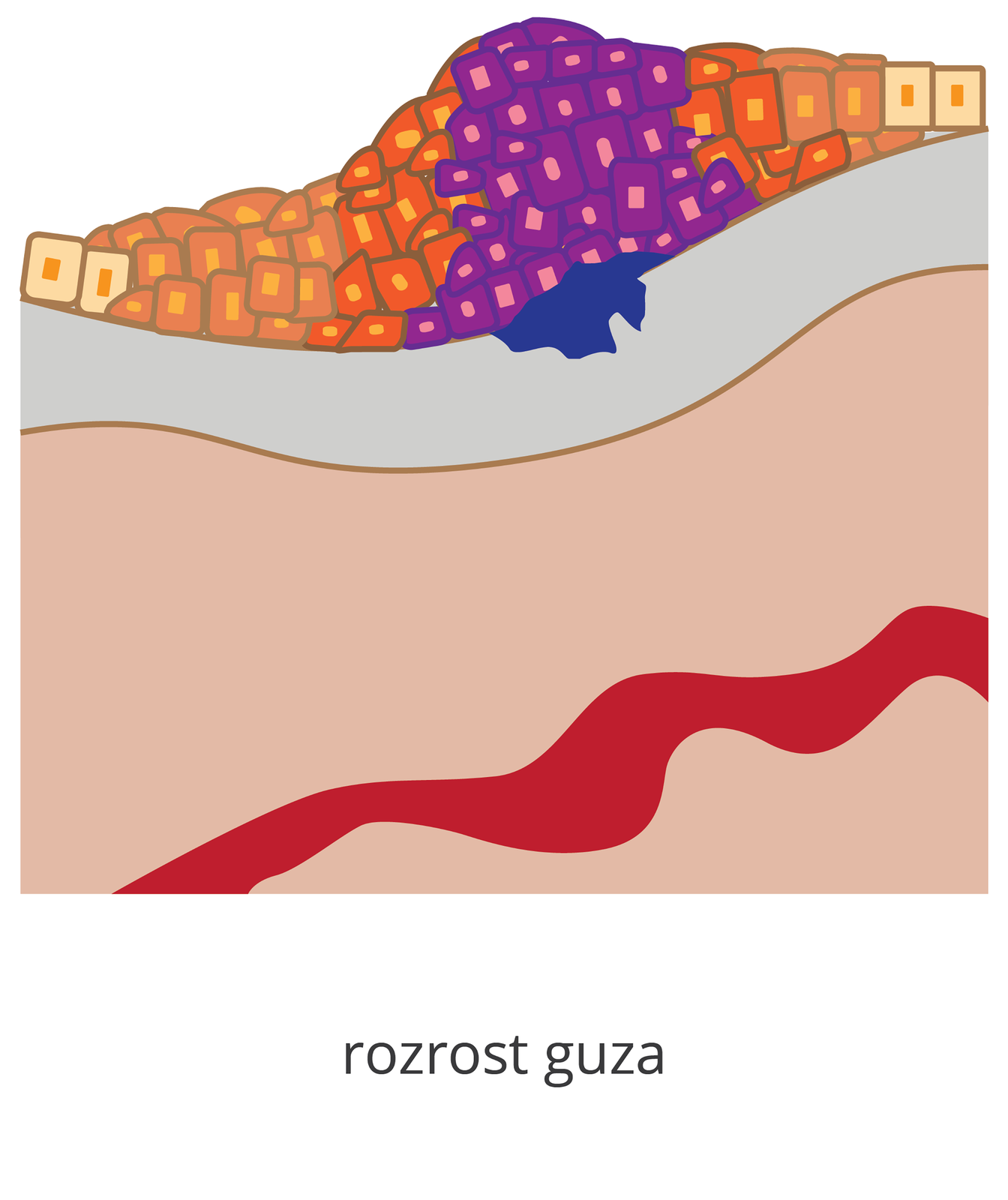 Ilustracja przedstawia węekszy guz, zmienione komórki występują już w 3 warstwach tkanek.