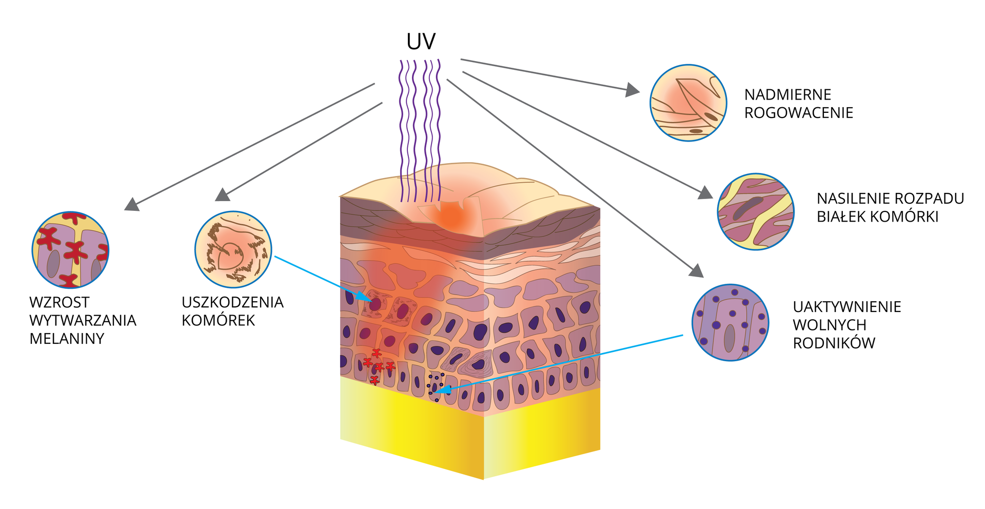 Ilustracja przedstawia schematycznie wpływ promieniowania UV na skórę. W centrum znajduje się duży sześcian, ilustrujący przekrój skóry. Od góry w jego wierzchnią warstwę uderzają faliste, fioletowe linie, czyli promienie ultrafioletowe. Wokół przekroju umieszczono kolejno powiększenia, ilustrujące uszkodzenia skóry przez promieniowanie i reakcję na nie. Po lewej stronie przekroju skóry znajdują się dwa powiększenia:  1.	Wzrost wytwarzania melaniny, który symbolizują czerwone gwiazdki pomiędzy fioletowymi, kwadratowymi ścianami komórek.  2.	Uszkodzenia komórek. Komórka ma brązowe, poszarpane brzegi. Po prawej stronie przekroju skóry znajdują się trzy powiększenia, kolejno od góry: 1.	Nadmierne rogowacenie. Brązowe łuski to najstarsze komórki, ale z jądrami. Niektóre zadzierają się do góry. Na powierzchni skóry wskazano, że w tym miejscu wyraźnie się zapada. 2.	Nasilony rozpad białek komórki. Kilka liliowych pasm jest przeciętych żółtymi pasmami. 3.	Uaktywnienie wolnych rodników. Z liliowych komórek unoszą się fioletowe kropki.