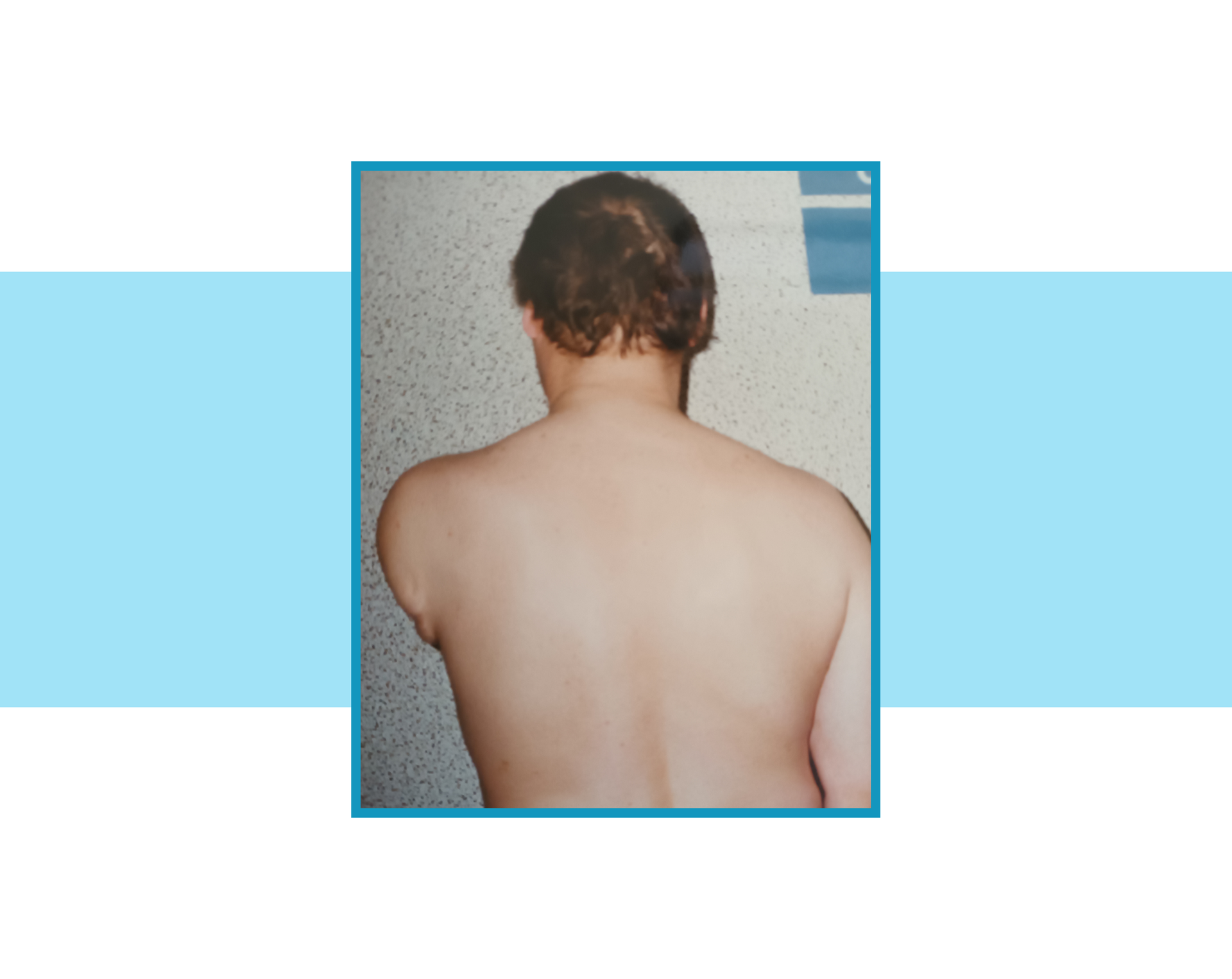 Zdjęcie przedstawia pacjent po amputacji na poziomie  ramienia  z bardzo krótkim kikutem.
