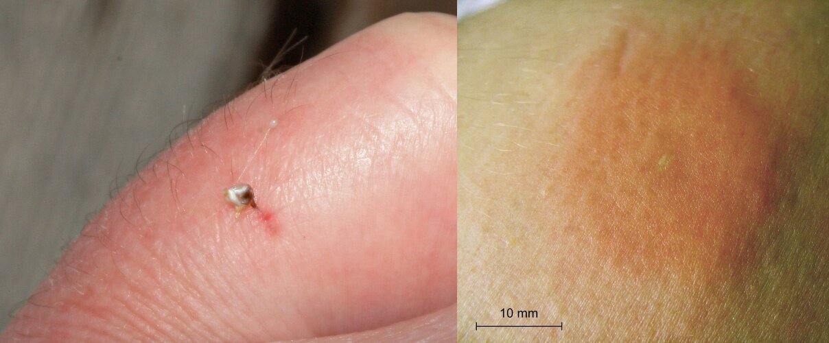 Fotografia przedstawiająca urwane, wbite w skórę żądło owada. Po prawej zdjęcie obrzęku w czerwonym kolorze na skórze.