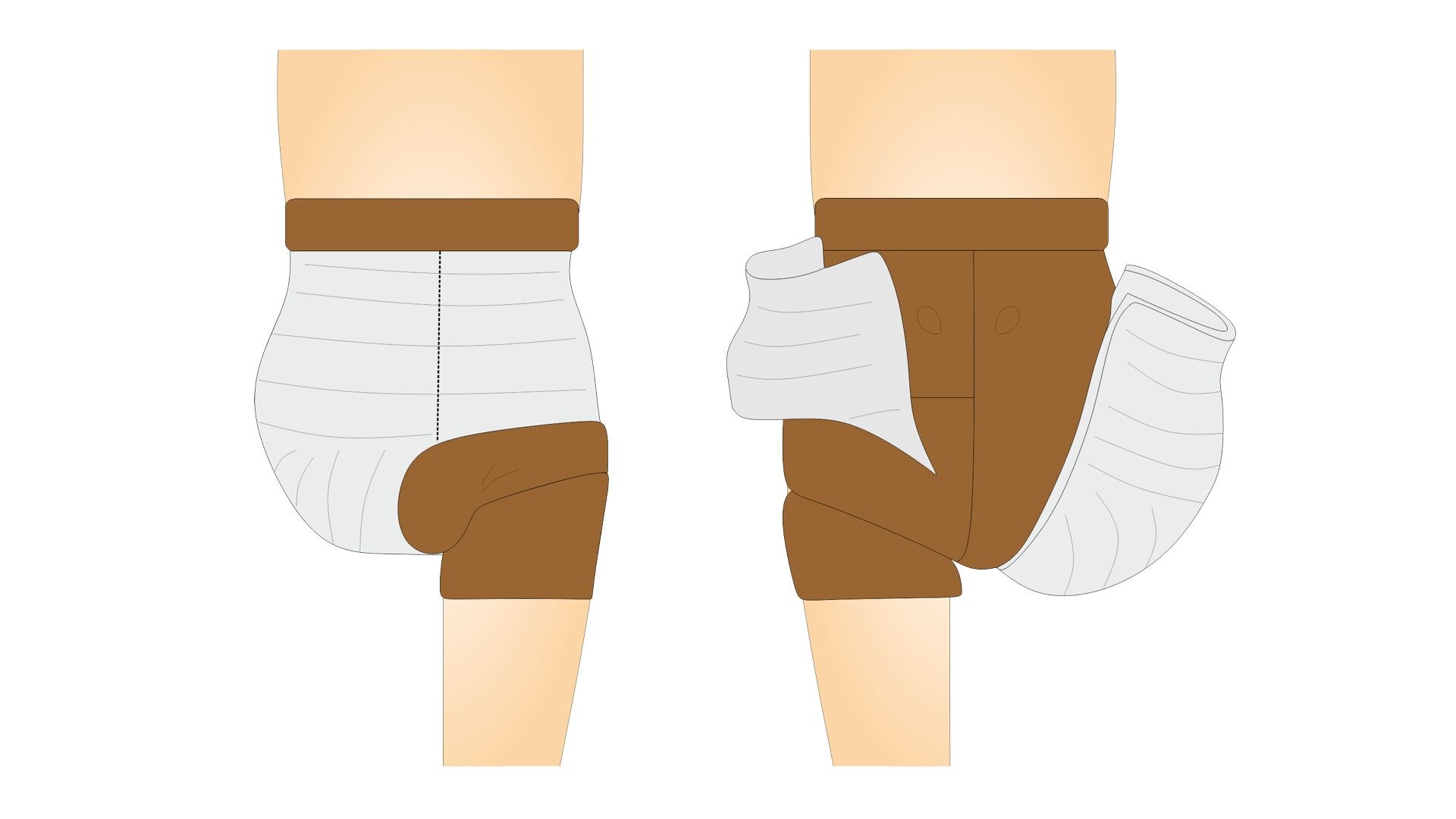 Rycina przedstawia budowę człowieka od przodu i od tyłu, od pasa do stawu kolanowego. Prawa kończyna dolna została amputowana na wysokości pachwiny. Na wysokości miednicy znajdują się opaski gipsowe. Są one rozcięte pionowo od przodu miednicy. 