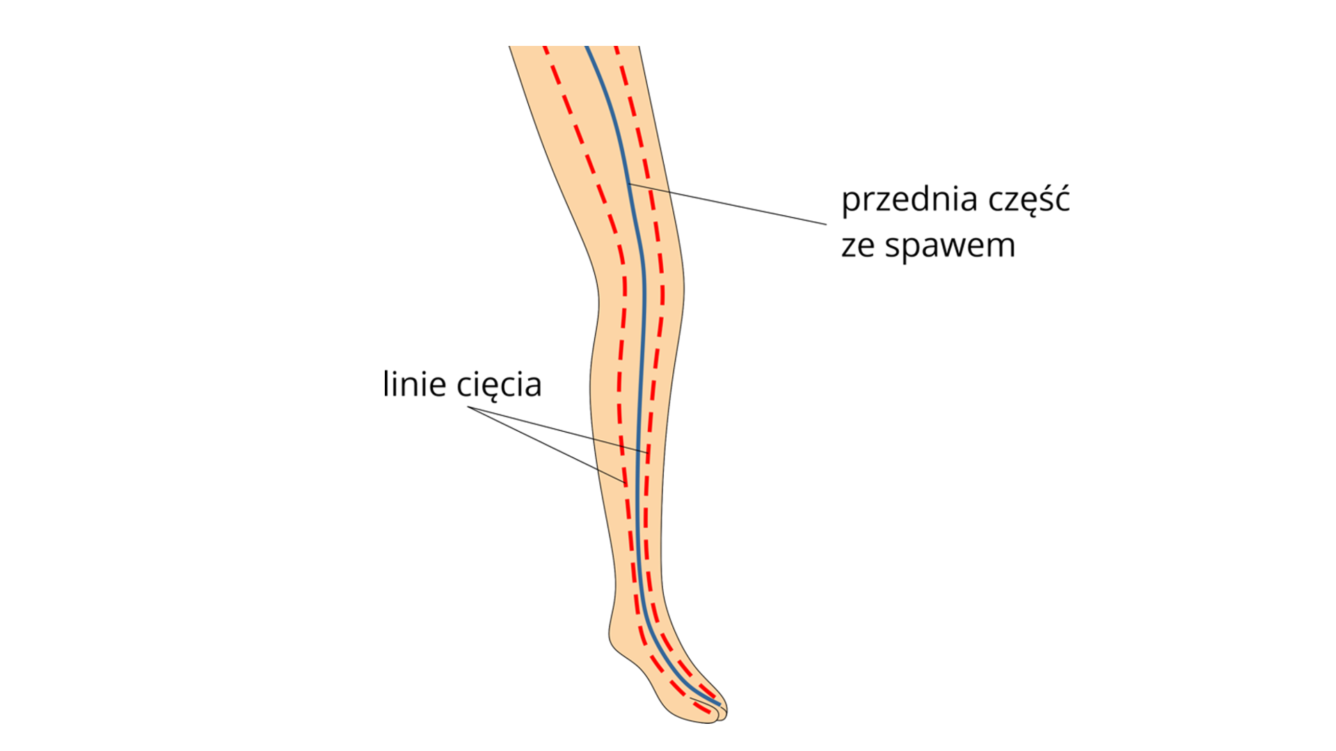 Schemat kończyny dolnej z zaznaczoną przednią częścią ze spawem oraz liniami cięcia po obu stronach spawu.