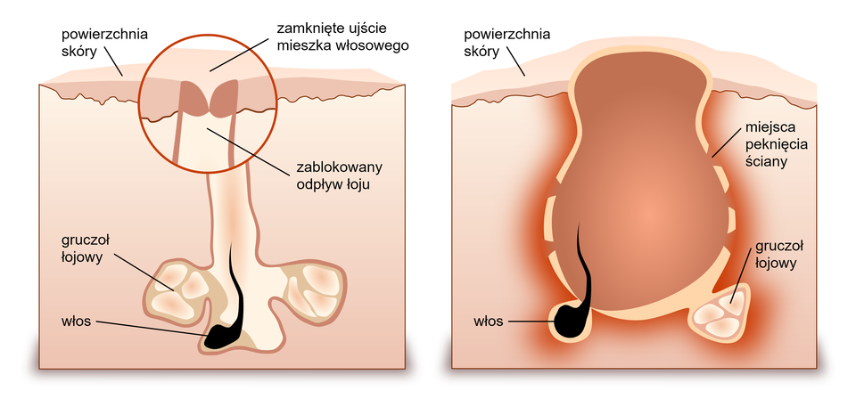 Grafika przedstawia przekroje skóry człowieka z zaznaczonym mieszkem włosowym i gruczołem łojowym. Po lewej stronie widoczny jest zatkany mieszek włosowy – u góry zamknięte ujście blokuje odpływ łoju, co powoduje jego gromadzenie. Obok, po prawej stronie, pokazano dalszy etap – powiększony, zaczerwieniony obszar pod skórą, w którym nadmiar łoju doprowadził do rozciągnięcia i pęknięcia ściany mieszka. W obu przekrojach zaznaczono włos, gruczoł łojowy oraz powierzchnię skóry.