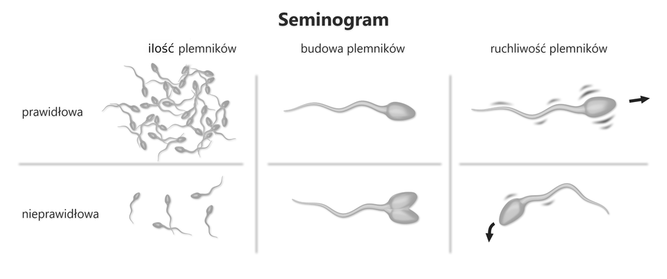 Ilustracja przedstawia seminogram. Zestawione są ilustracje prezentujące prawidłową i nieprawidłową koncentrację plemników, budowę plemników oraz ruchliwość plemników. Prawidłowa koncentracja plemników ukazuje dziesiątki plemników kłębiących się przy sobie. Nieprawidłowa koncentracja plemników wskazuje na zaledwie pięć plemników w znacznej odległości od siebie. Prawidłowo zbudowany plemnik ma główkę i witkę, nieprawidłowo zbudowany plemnik posiada dwie główki i jedna witkę. Prawidłowa ruchliwość plemników jest duża, plemnik wędruje przed siebie. Nieprawidłowa ruchliwość plemnika cechuje się jego powolnymi ruchami i podążaniem w dół.