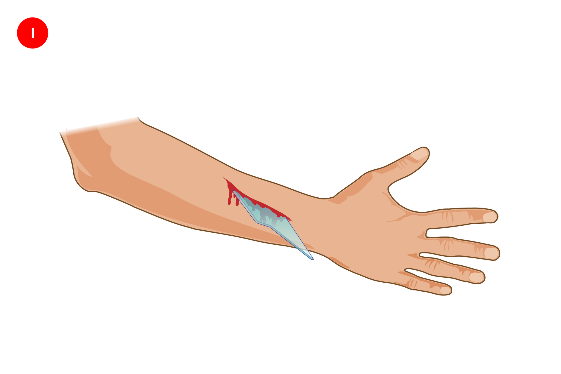 Ilustracja prezentująca sposób opatrywania rany z ciałem obcym. Prawa ręka skierowana zewnętrzną stroną do obserwatora, z wyprostowanymi palcami po prawej stronie. Powyżej nadgarstka podłużne miejsce zranienia ze wbitym kawałkiem szkła tkwiącym pionowo w ranie.