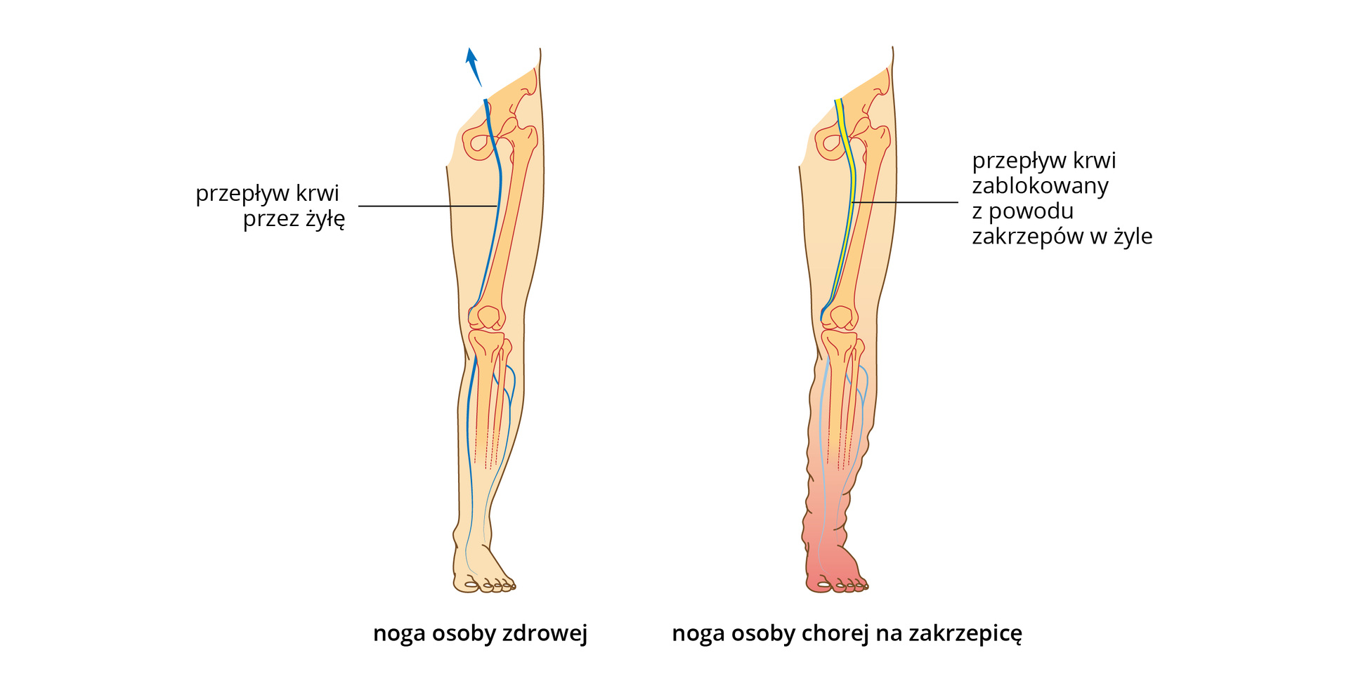 Ilustracja przedstawia różowe sylwetki nóg człowieka, z wrysowanymi kośćmi i żyłami. Noga po lewej jest zdrowa. W nodze po prawej u góry żółtym kolorem ukazano zakrzepy, blokujące żyłę. Noga na dole jest zaczerwieniona i obrzęknięta.