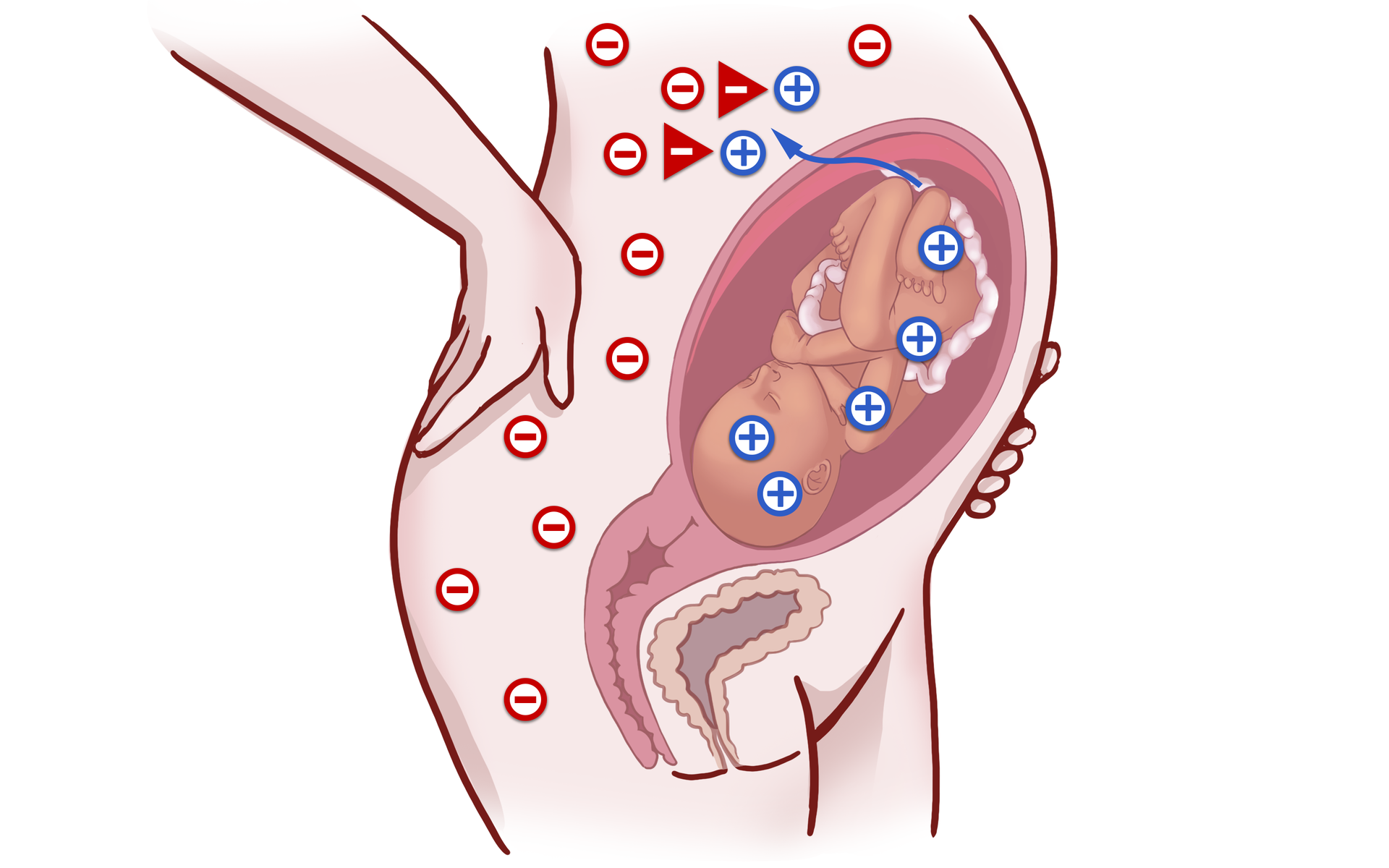 Grafika przedstawia przekrój ciała kobietę w ciąży. Na jej ciele widoczne są minusy, sygnalizujące grupę krwi Rh-. Natomiast płód posiada grupę krwi Rh+, sygnalizowaną przez plusy na jego ciele. Dochodzi do kontaktu krwi matki z krwią płodu, co powoduje wytworzenie we krwi matki przeciwciał anty‑D.