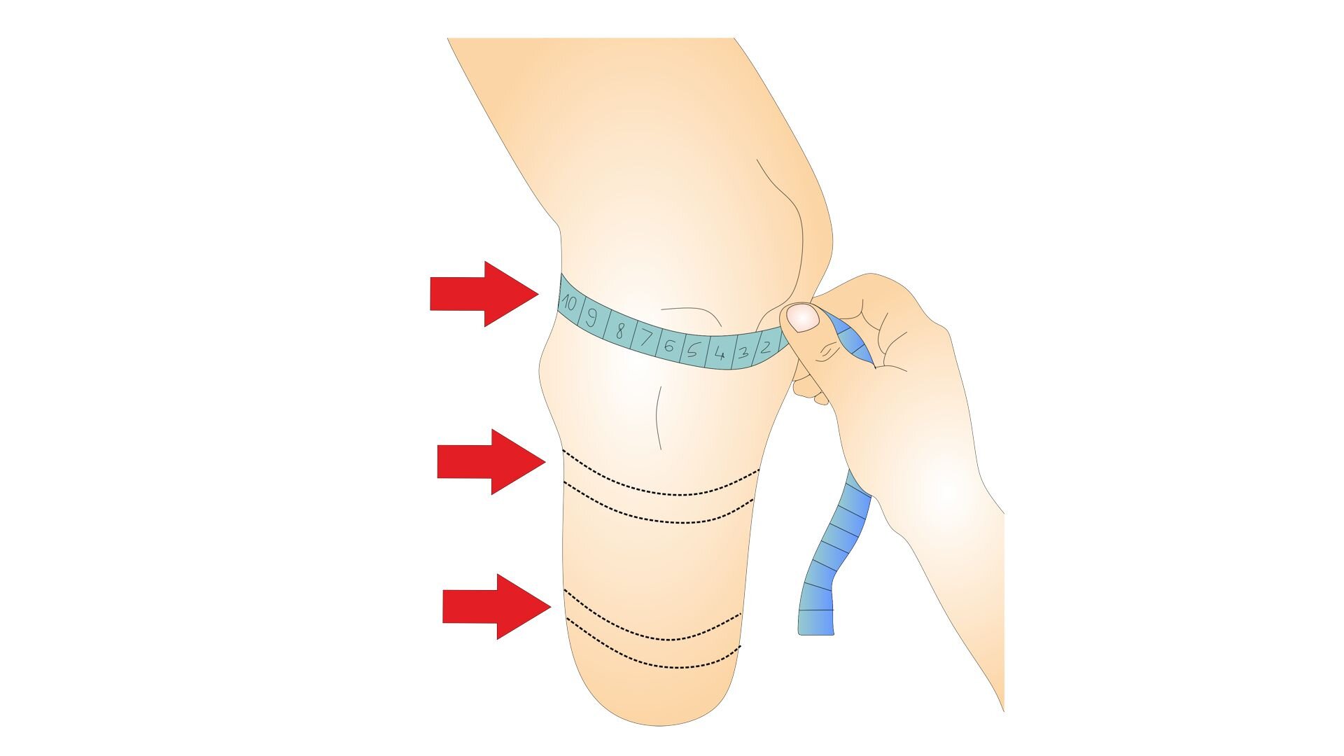 Rycina przedstawia kończynę dolną po amputacji na wysokości połowy łydki. Na grafice znajduje się dłoń osoby dokonującej pomiarów kikuta. Zamieszczone na rycinie strzałki pokazują kolejność wykonywania tej czynności. Pierwszego pomiaru dokonuje się poniżej rzepki, drugiego – na środku kikuta, a trzeciego – na jego szczycie. 