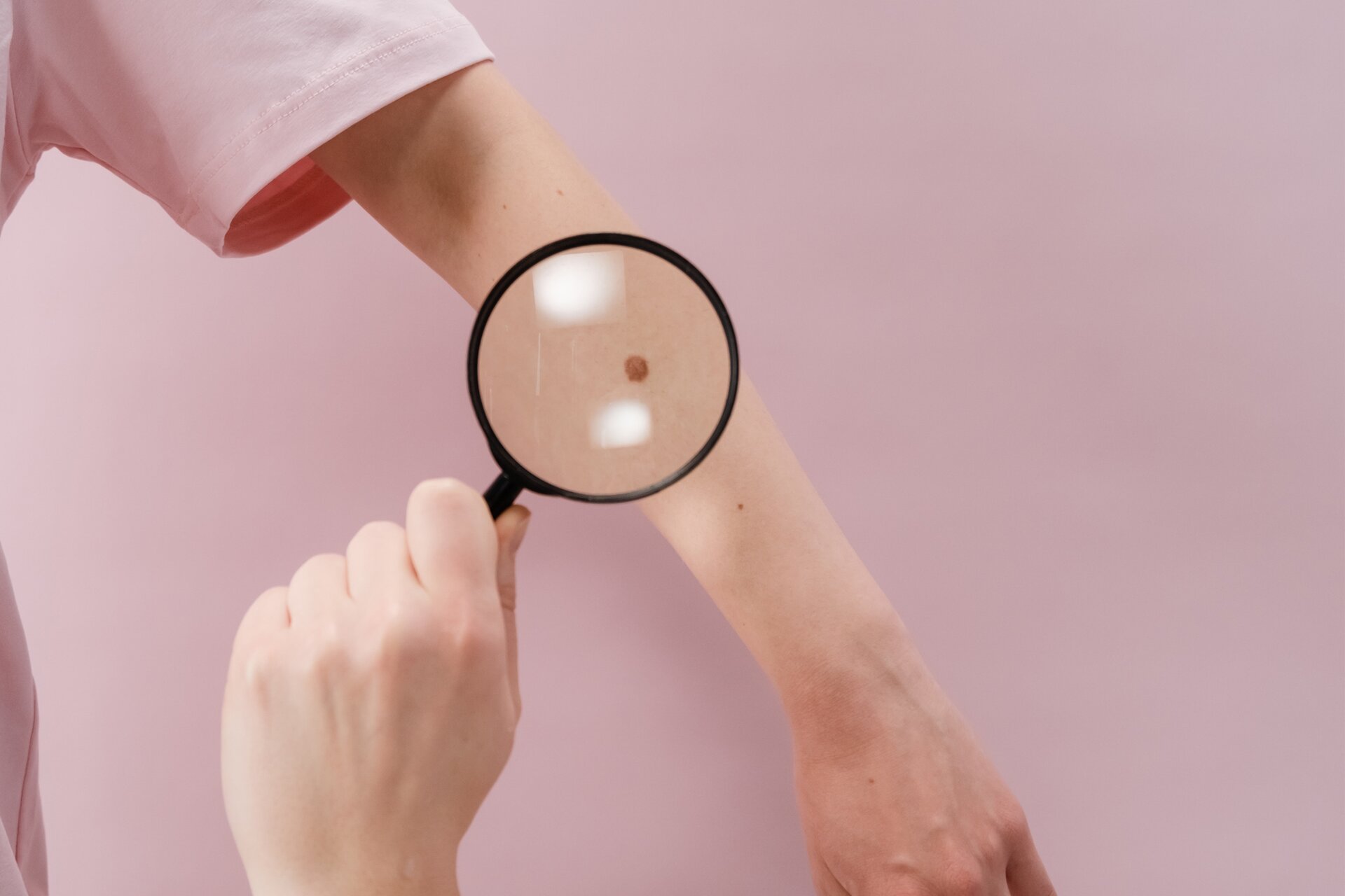 Na zdjęciu widoczne są ręce dwóch osób. Jedna z nich trzyma lupę i przykłada do przedramienia drugiej osoby. W powiększeniu widoczne jest znamię na ręce. 