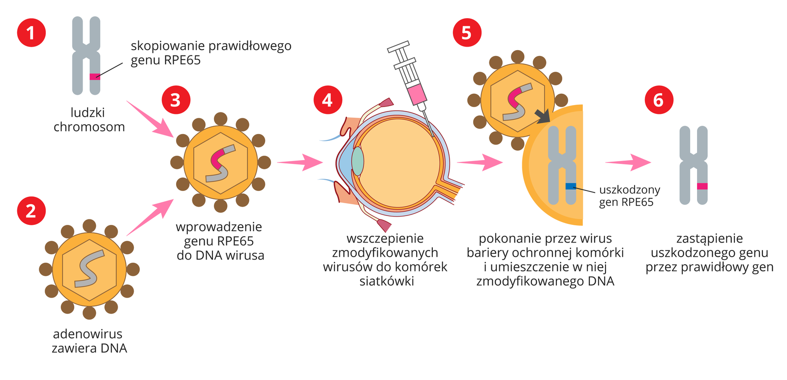 Rysunek schematycznie przedstawia etapy leczenia wrodzonej ślepoty Lebera. Najpierw następuje skopiowanie prawidłowego genu RPE65 z ludzkiego chromosomu, następnie jest on wprowadzany do DNA adenowirusa, ten zaś zostaje wstrzyknięty do komórek siatkówki. Następnie wirus pokonuje barierę ochronną komórki i umieszcza w niej zmodyfikowane DNA. Wówczas uszkodzony gen zostaje zastąpiony prawidłowym.