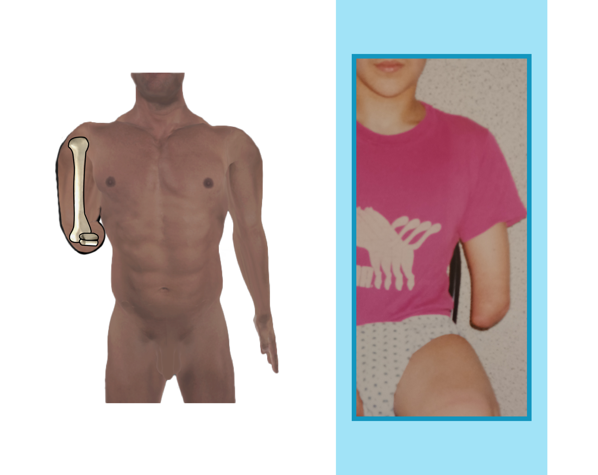  Grafika i zdjęcie przedstawiające pacjenta z bardzo krótkim kikutem przedramienia. 