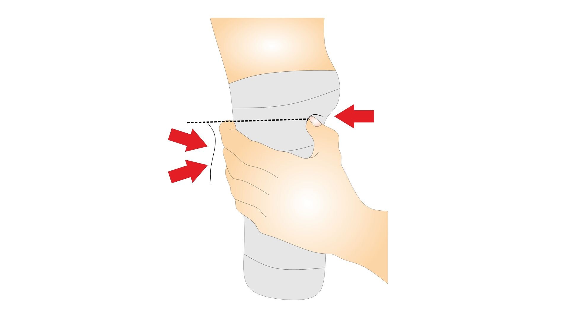 Rycina przedstawia kończynę dolną po amputacji na wysokości połowy łydki. Powierzchnia całego kikuta jest owinięta bandażem gipsowym. Na grafice znajdują się również strzałki, które wskazują miejsce dociskania bandaży. Osoba opatrująca kikut trzyma dłoń pod stawem kolanowym pacjenta, dociskając kciukiem pod rzepką. 