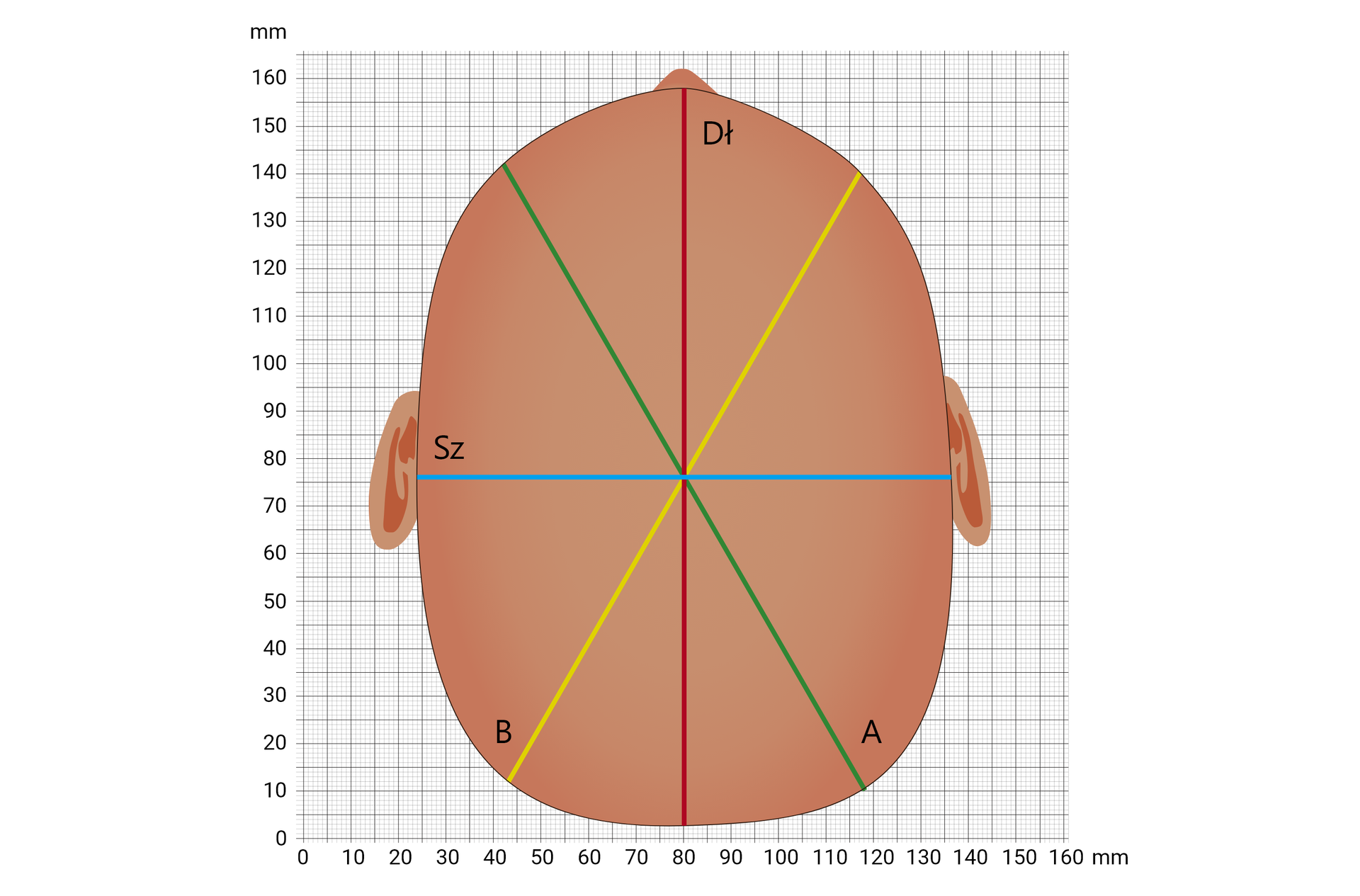 Grafika przedstawiająca przykładową czaszkę dziecka z brachycefalią symetryczną. Na zamieszczonym na siatce milimetrowej schemacie zaznaczono odległości: skośną krótszą, skośną dłuższą, szerokość i długość.