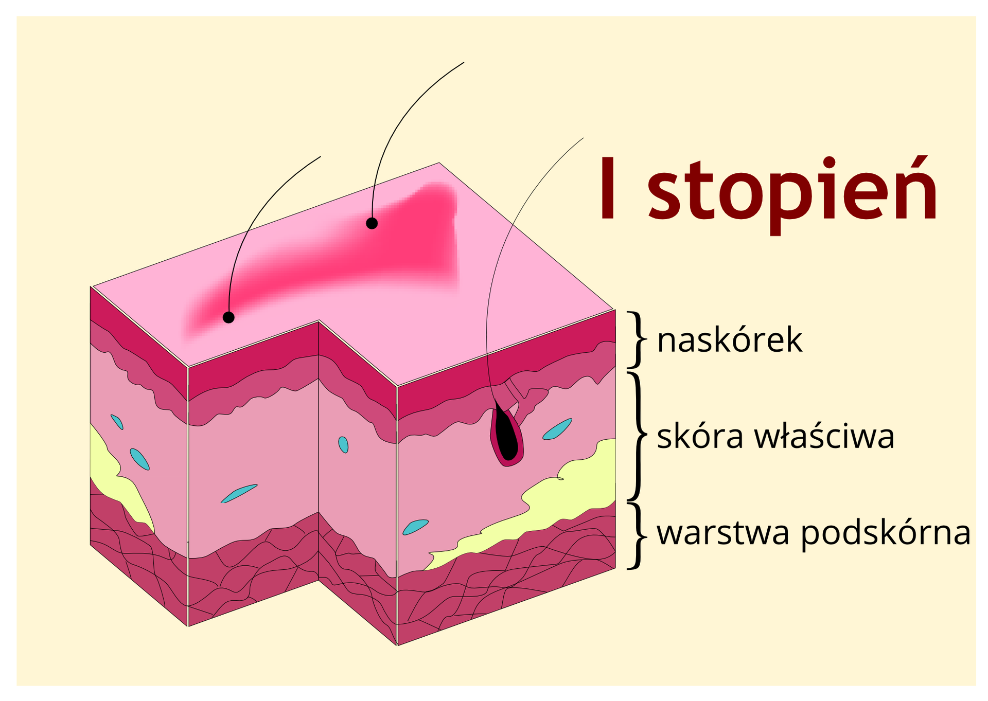 Kliknij żeby powiększyć Pierwszy stopień oparzenia skóry. Wycinek skóry w kształcie prostopadłościanu. Skóra jest podzielona na trzy warstwy: na samej górze mieści się naskórek, poniżej skóra właściwa, zaś najgłębiej warstwa podskórna. Łodygi włosowe wyrastają przez naskórek. Mieszek włosowy czarny w skórze właściwej. Niewielka czerwona plama na naskórku.