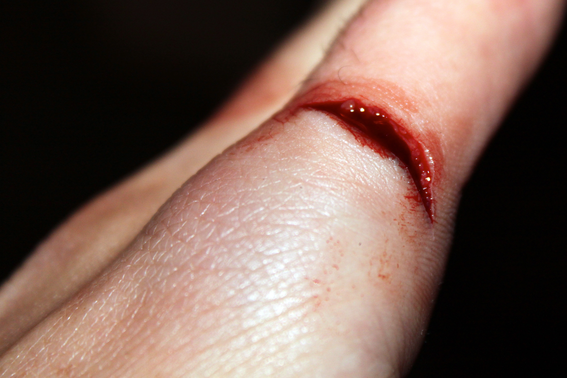 Zdjęcie przedstawia ranę ciętą. Zbliżenie na palce lewej dłoni. Poprzeczna rana cięta powyżej zgięcia palca wskazującego. Rana otwarta wypełniona krwią.