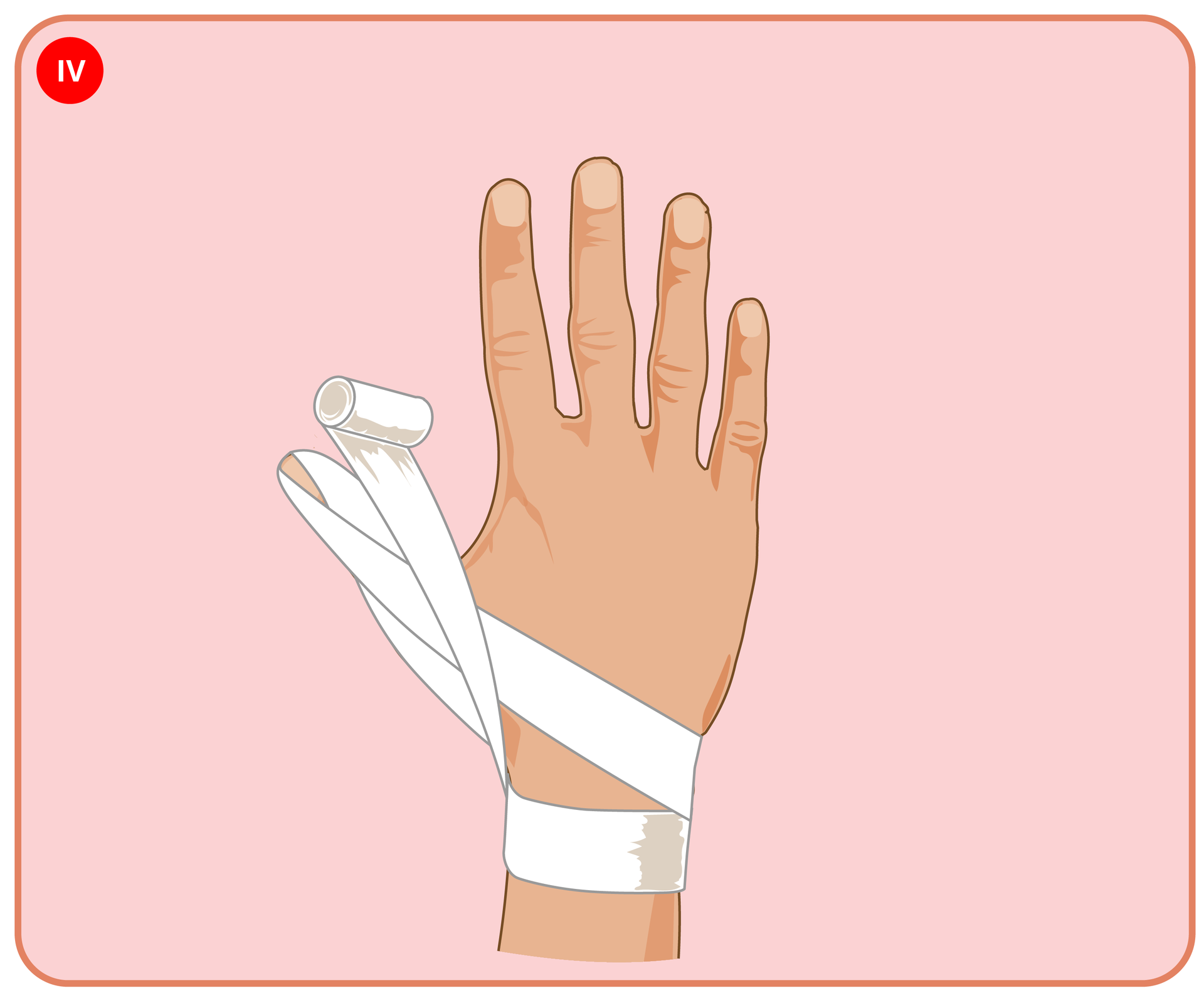 Fotografia przedstawia wykonanie bandażem kłosowania na kciuku.