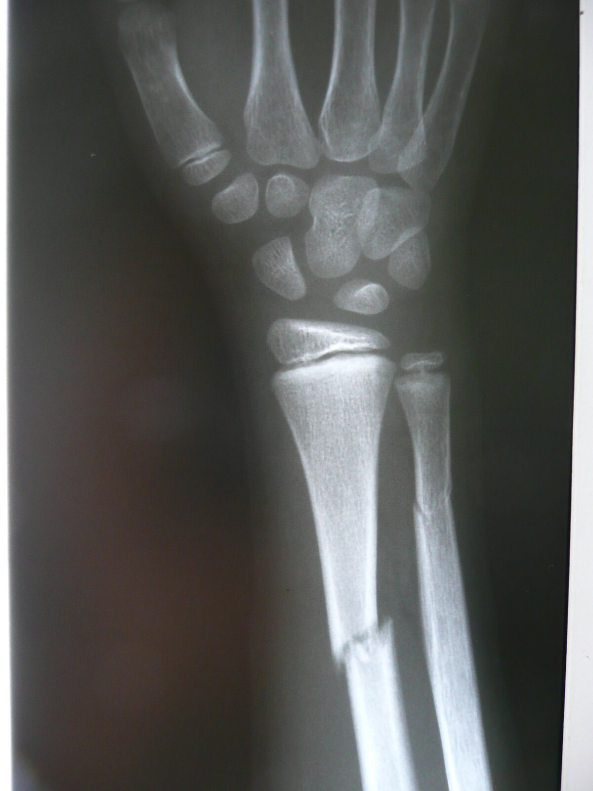 Rys. a. Na zdjęciu widać u góry kości dłoni. Poniżej łączą się z kośćmi dłoni dwie, pionowo ustawione, długie kości przedramienia. Lewa kość jest złamana, a dwie części są przesunięte względem siebie. Prawa kość jest pęknięta.