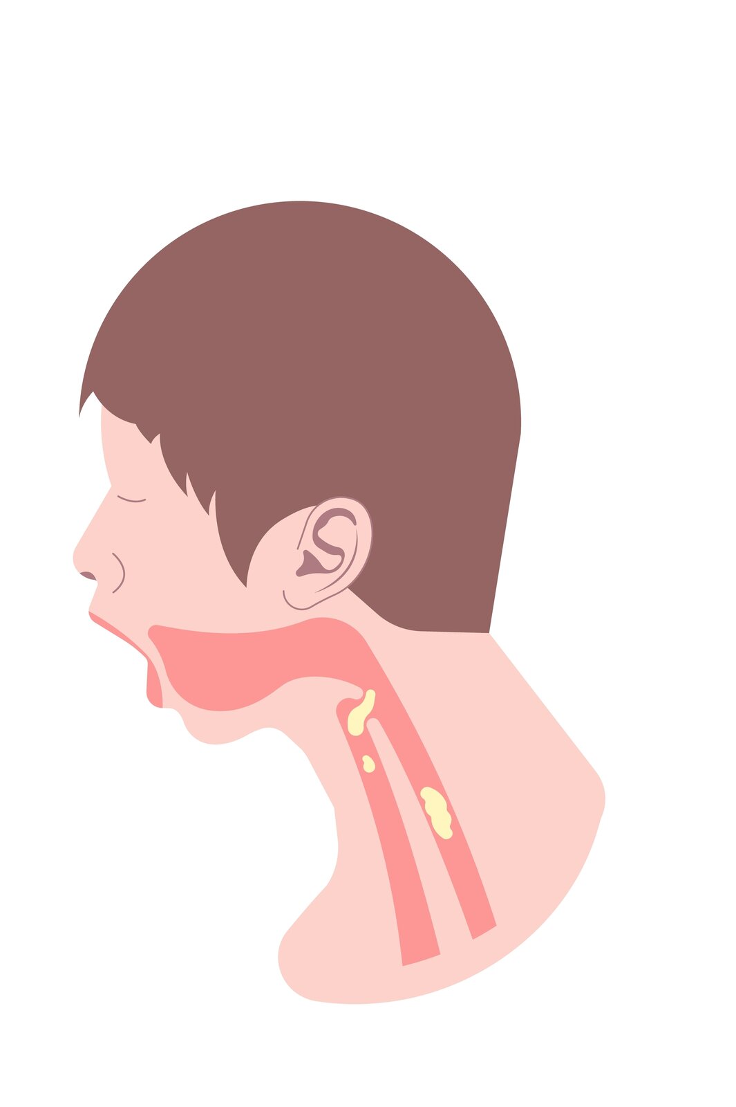 Kliknij, aby powiększyć. Ilustracja przedstawiająca młodego chłopca ukazanego z profilu. Otwiera on usta. Na ilustracji został zaznaczony układ oddechowy, w którym zalegają kawałki jasnego jedzenia.