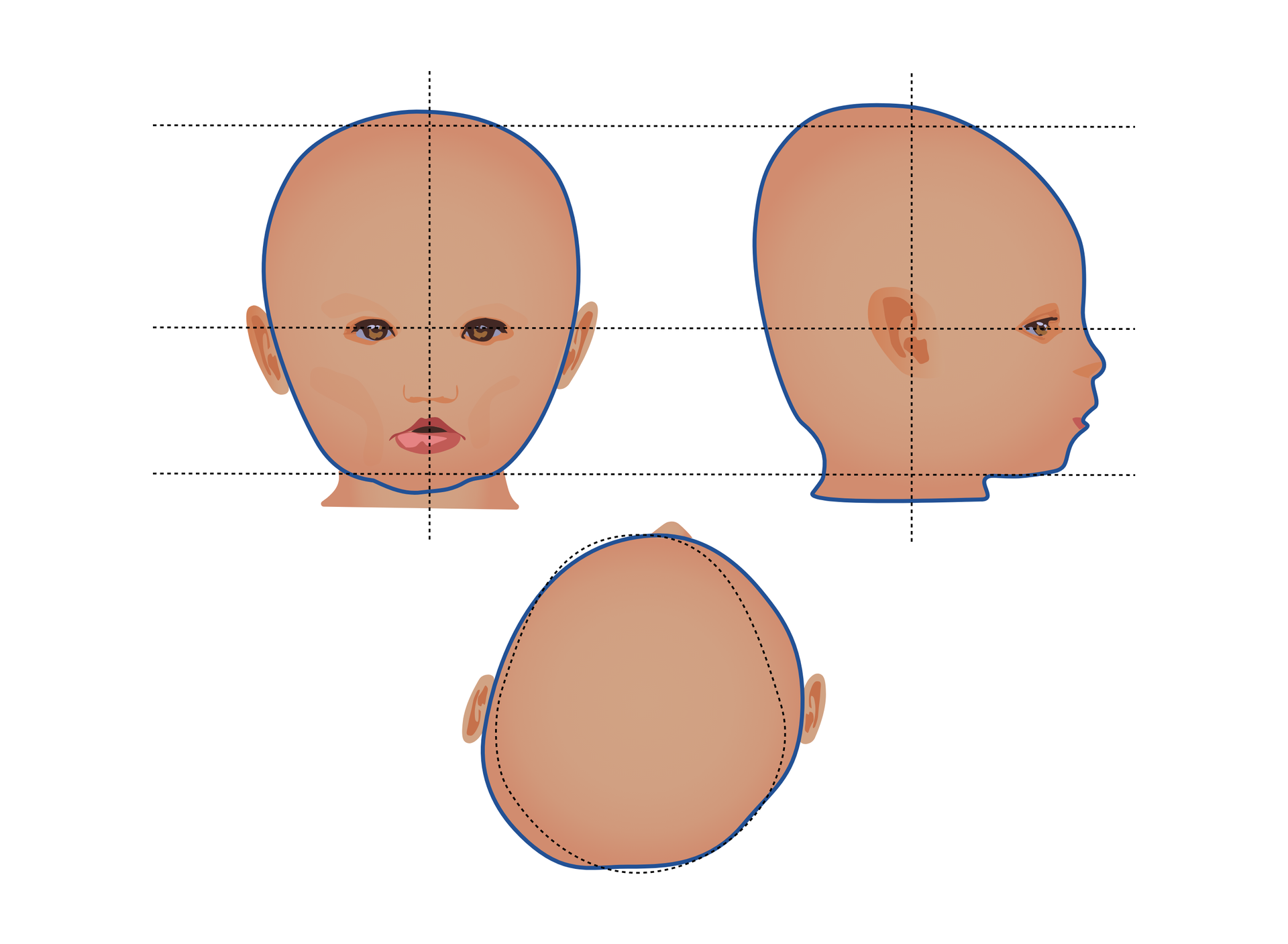 Schemat głowy dziecka z brachycefalią asymetryczną przedstawiony z przodu, góry i boku. Głowa jest asymetrycznie spłaszczona bocznie, co najlepiej uwidacznia rzut z góry.
