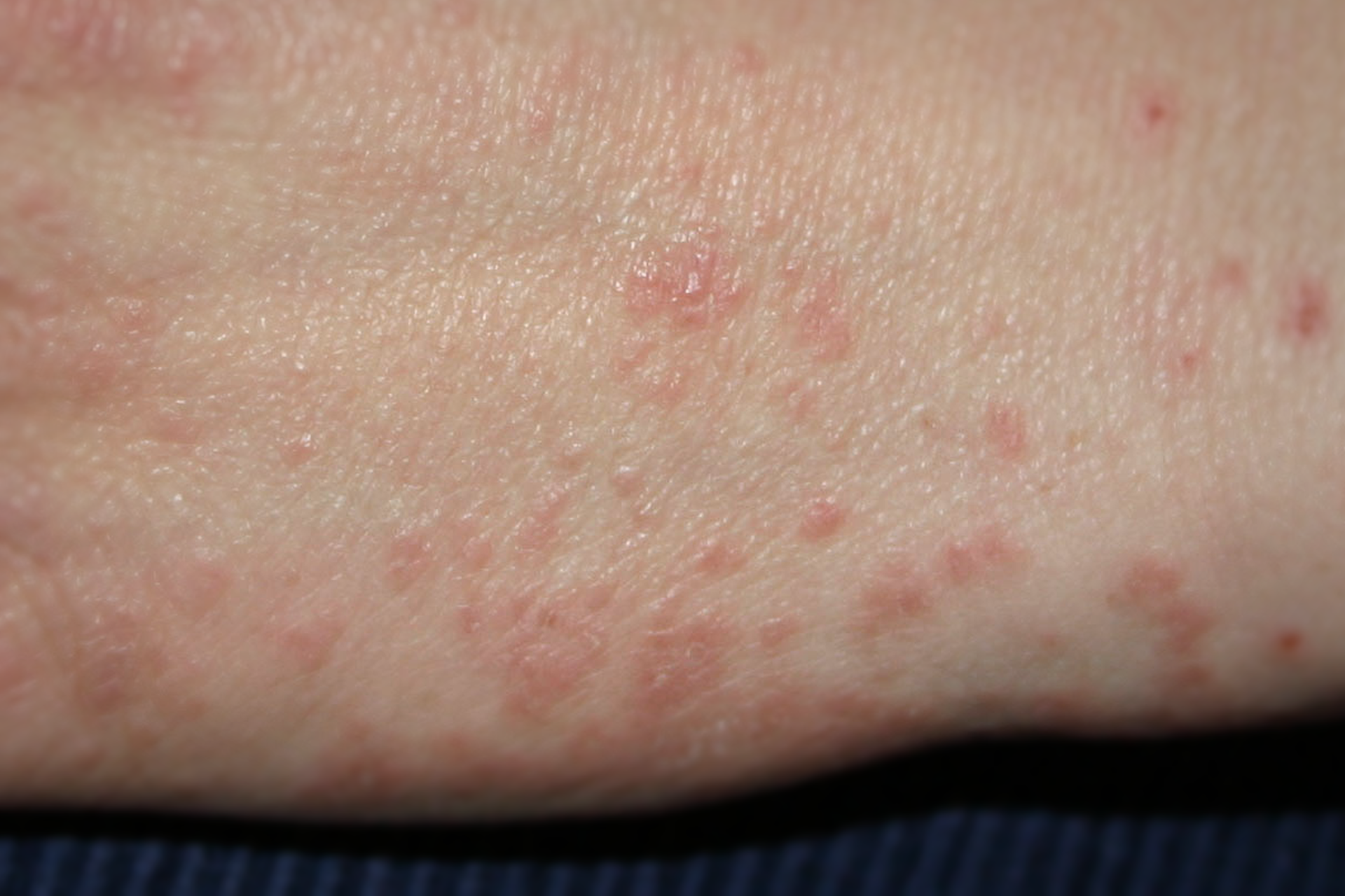 Na zdjęciu skóra z objawami świerzbu, widoczne czerwone plamki na skórze.