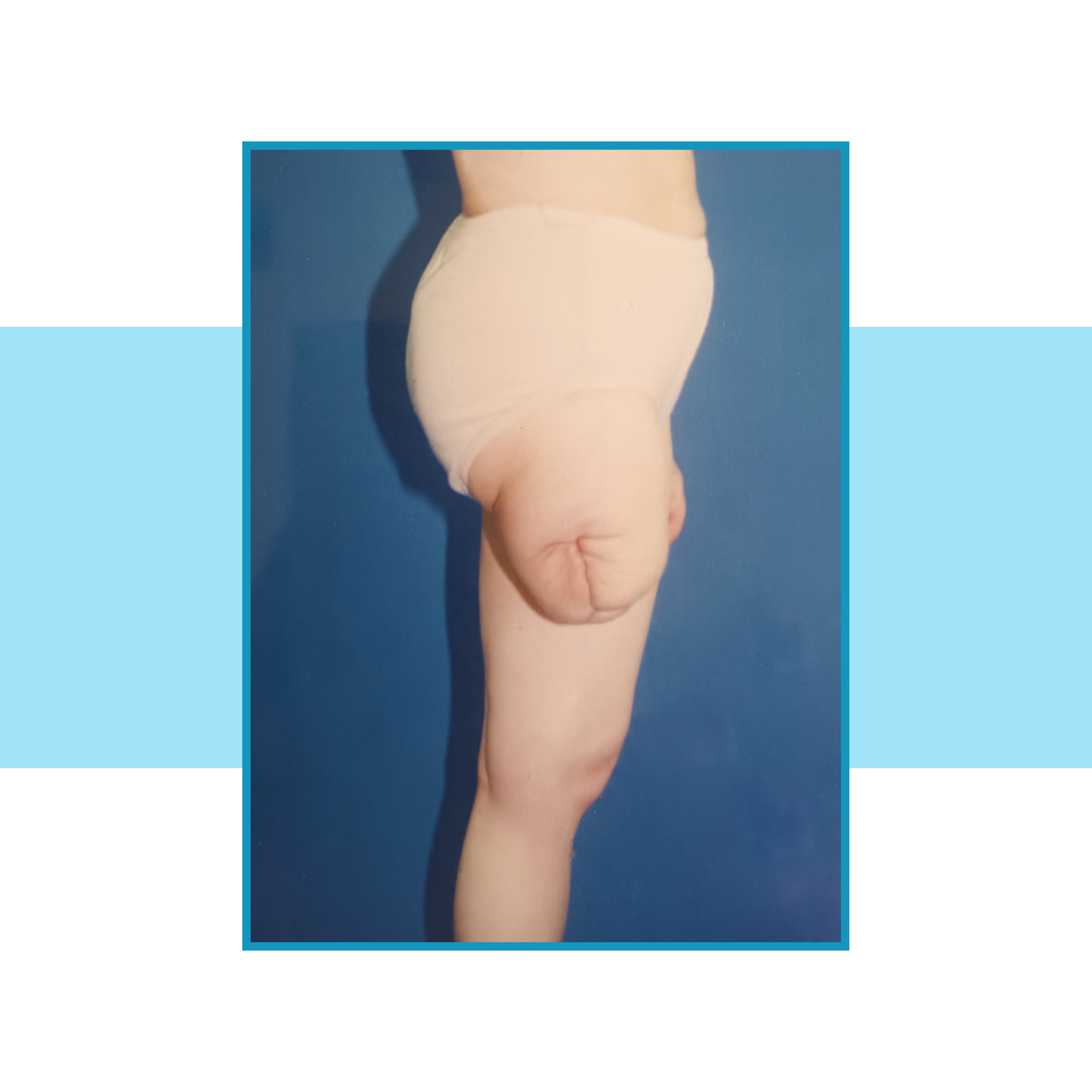 Zdjęcie kikuta problemowego kończyny dolnej. Kikut jest krótki, nieregularny i pomarszczony, z wyraźną blizną po amputacji kończyny.
