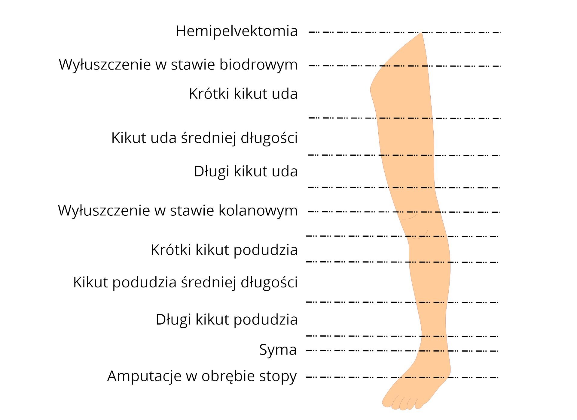 Grafika przedstawia lewą kończynę dolną człowieka z oznaczeniami w formie poziomych linii. Oznaczenia przedstawiają poziomy amputacji kończyny dolnej. Od góry, Hemiplewektomia, czyli amputacja poziomie miednicy, Wyłuszczenie w stawie biodrowym, czyli amputacja poniżej miednicy. Poniżej znajdują się kolejne oznaczenia czyli Krótki kikut uda, Kikut uda średniej długości i Długi kikut uda, który znajduje się nad stawem kolanowym. Poniżej znajduje się oznaczenie Wyłuszczenia w stawie kolanowym. Następnie oznaczone są amputacje w obrębie podudzia czyli Krótki kikut podudzia, Kikut podudzia średniej długości i Długi kikut podudzia. Poniżej znajduje się Syma, czyli amputacja powyżej kostki. Na dole znajduje się oznaczenie Amputacja w obrębie stopy.