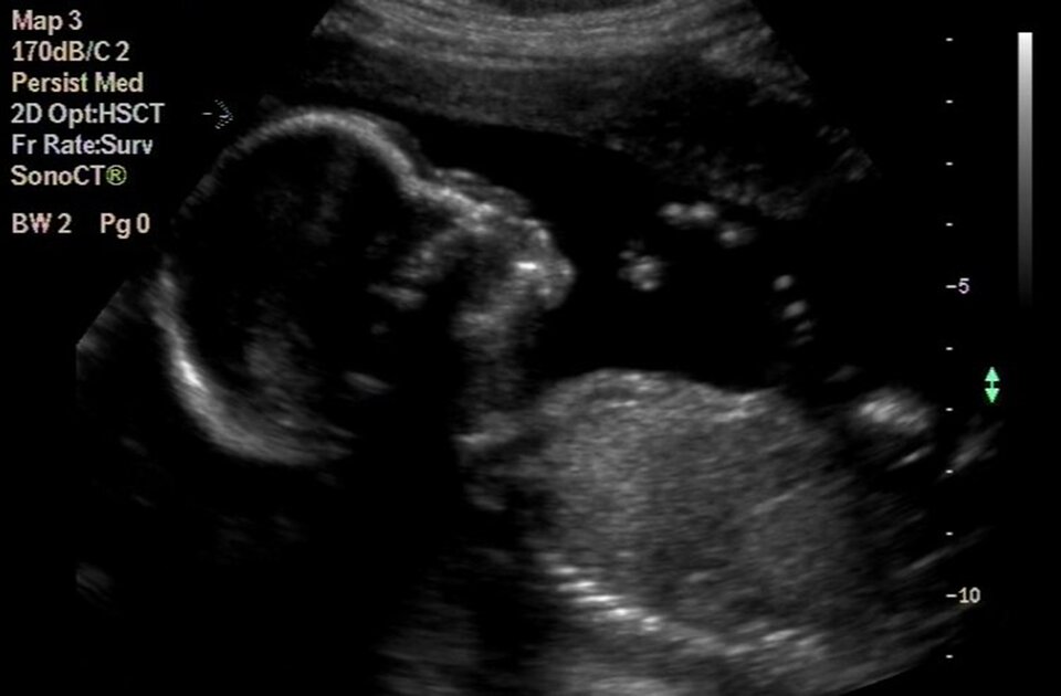 Zdjęcie przedstawia obraz ultrasonograficzny płodu. Widoczny jest prawy profil ciała  - głowa z zarysem czoła, nosa, ust, brody oraz widać tułów. 
