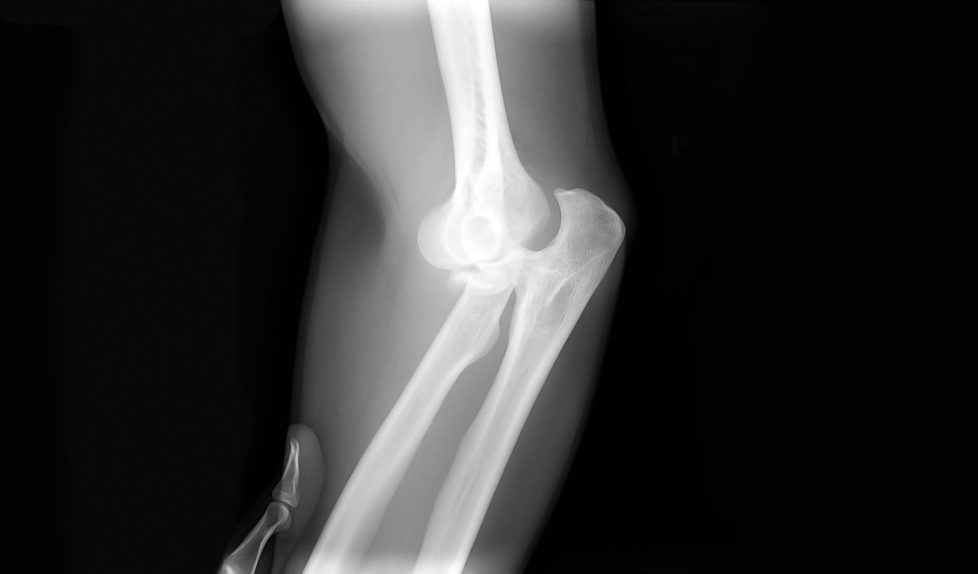 Zdjęcie RTG przedstawiające zwichniecie, kość w stawie jest przemieszczona.