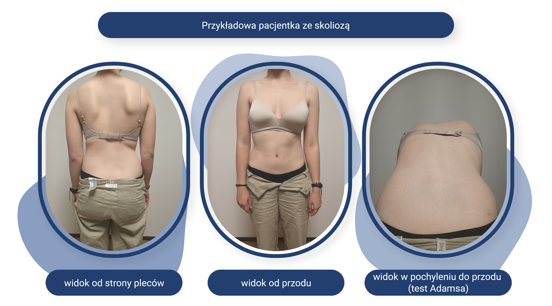 Plansza pod tytułem: Przykładowa pacjentka ze skoliozą. Plansza zawiera trzy zdjęcia z podpisami.
Zdjęcie opisane jako widok od strony pleców przedstawia pacjentkę stojącą tyłem. Widoczne są u niej asymetria na wysokości barków i osunięty niżej lewy bark. 
Zdjęcie opisane jako widok od przodu przedstawia pacjentkę stojącą przodem. Widoczne są u niej asymetria na wysokości barków i osunięty niżej lewy bark. 
Zdjęcie opisane jako widok w pochyleniu do przodu, test Adamsa, przedstawia pacjentkę stojącą tyłem z pochylonym w dół tułowiem. Widoczne są u niej asymetria grzbietu i osunięty lewy bark. 
