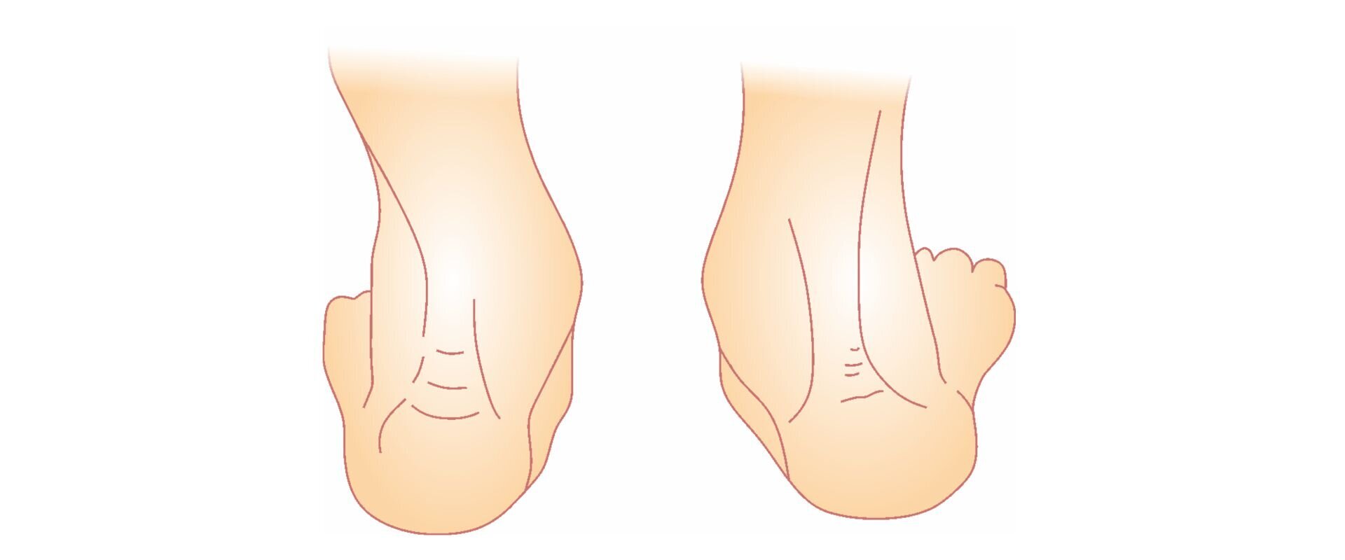 Grafika przedstawiająca stopy koślawe. Stopy są przekrzywione w kostce w stronę przyśrodkową.
