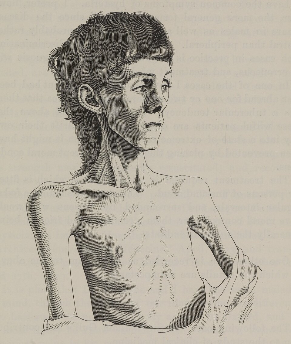 Grafika przedstawia osobę z jadłowstrętem psychicznym. Ma ona wychudzoną twarz z zapadniętymi policzkami. 