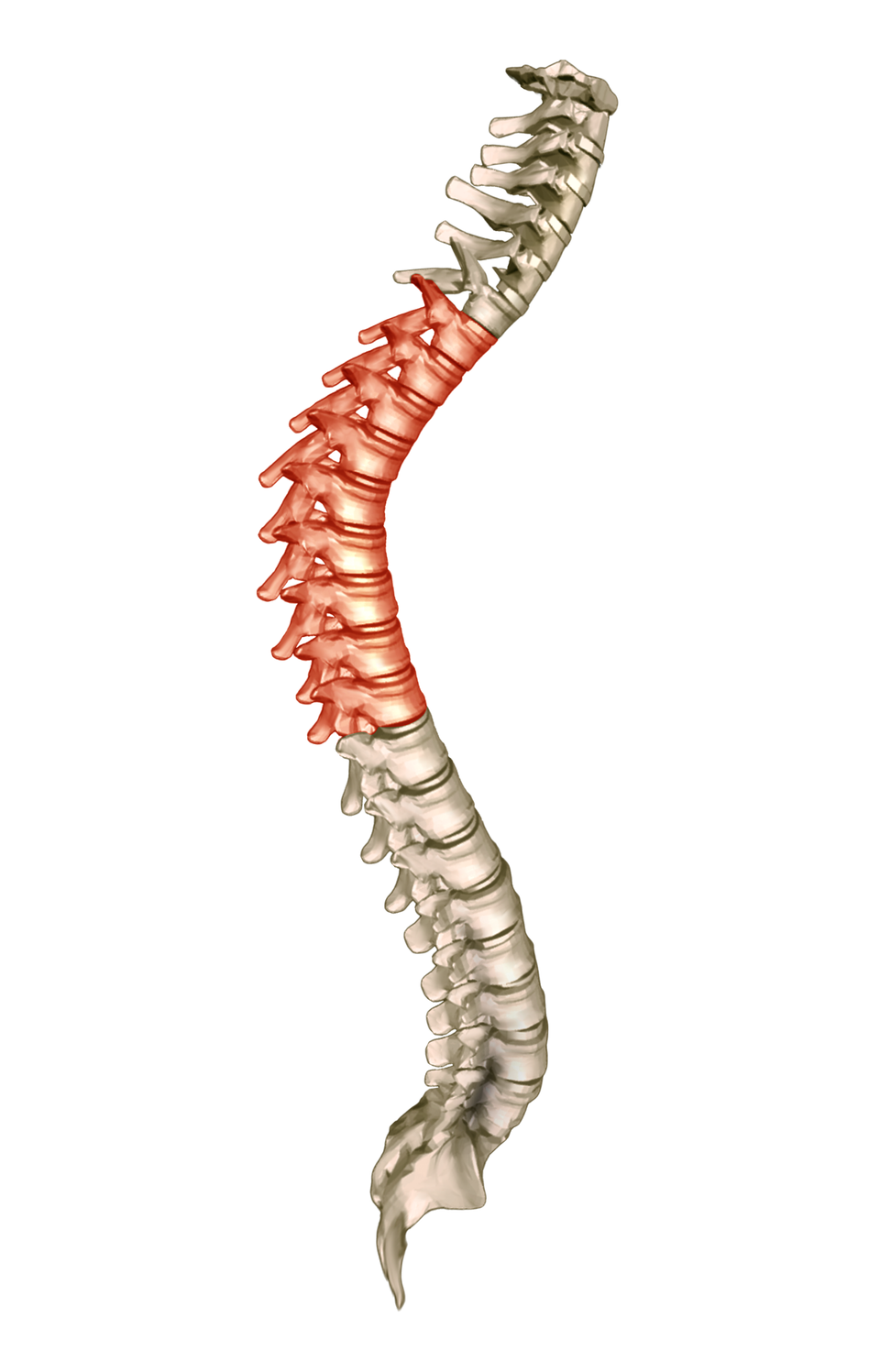 Na zdjęciu wygięty w literę S kręgosłup. Kolorem czerwony oznaczono nadmiernie wygięty do tyłu odcinek piersiowy. 