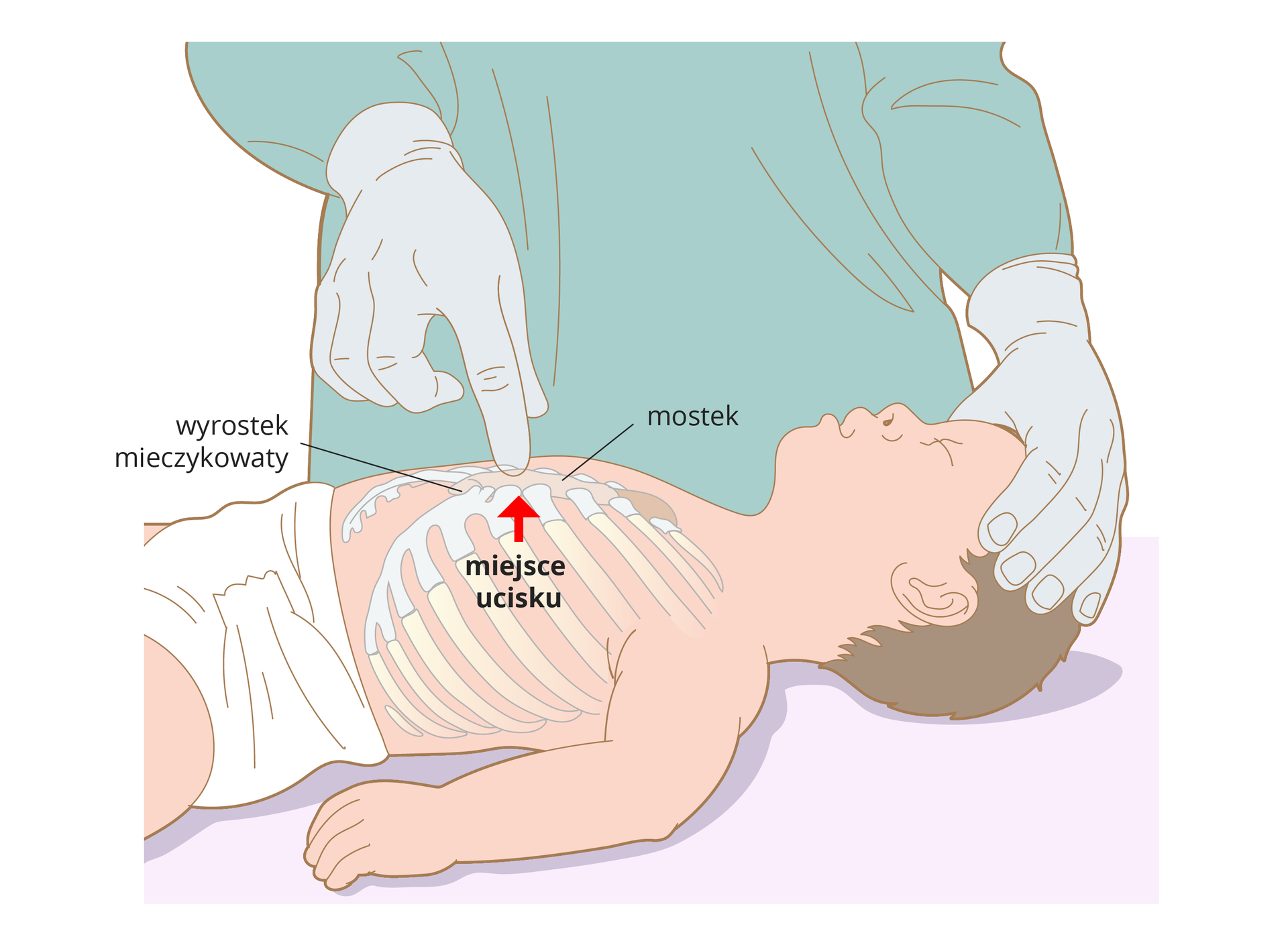 Ilustracja przedstawia niemowlę leżące na plecach bokiem do obserwatora. Niemowlę bez ubranka w samej pieluszce. Głowę przytrzymuje lekarz jedną ręką. Drugą ręką wskazuje na klatkę piersiową dziecka. Na ilustracji zaznaczone są żebra i mostek. Pionowa strzałka wskazuje miejsce ucisku znajdujące się w dolnej części mostka.