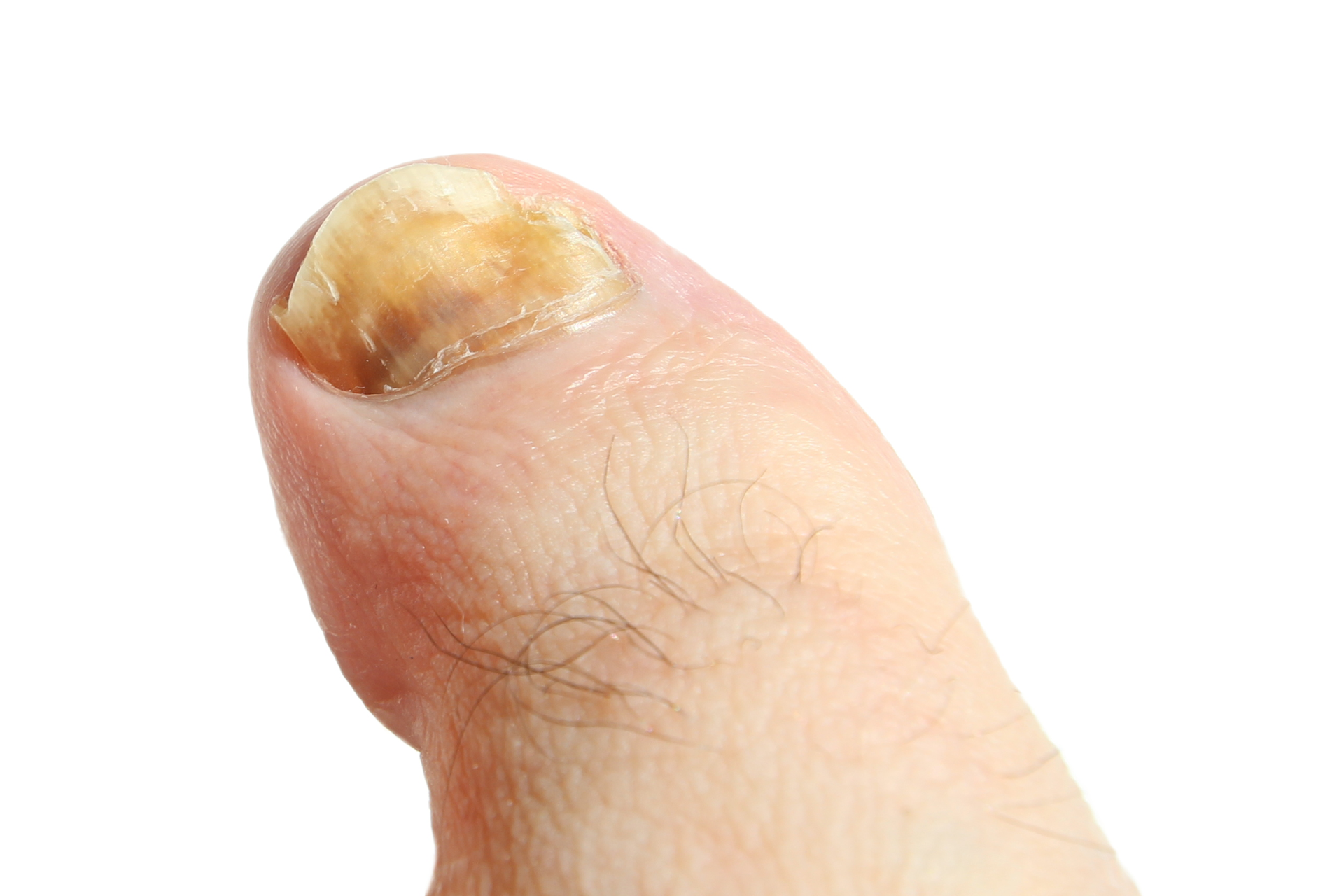 slajd 3 - paznokieć palca zaatakowany grzybicą