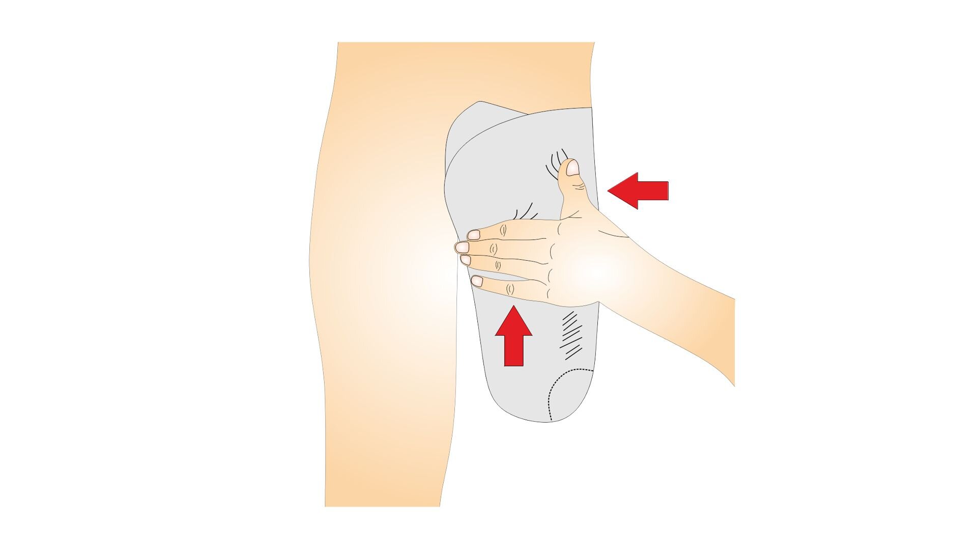 Rycina przedstawia budowę człowieka od tyłu, od pasa do stawu kolanowego. Prawa kończyna została amputowana na wysokości stawu kolanowego. Kikut owinięty jest opaską gipsową. Na grafice znajdują się strzałki wskazujące miejsca formowania opaski. Osoba opatrująca kikut trzyma dłoń tak, że cztery jej palce spoczywają pod pośladkiem pacjenta, a kciuk leży na wysokości środka jego pośladka. 