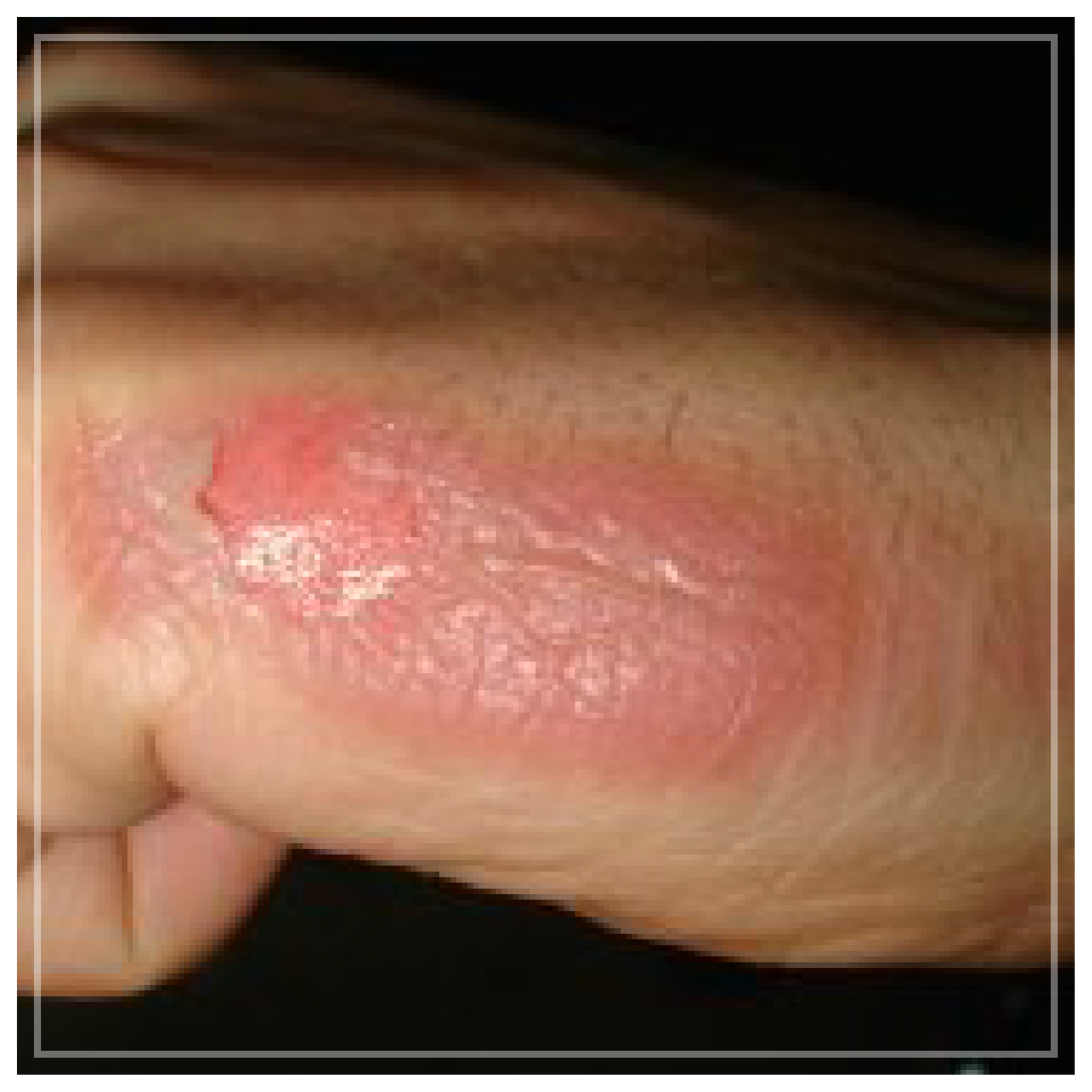 Na zdjęciu widoczna jest poparzona od boku dłoń. Na zewnętrznej części dłoni widoczne jest duże zaczerwienienie. 