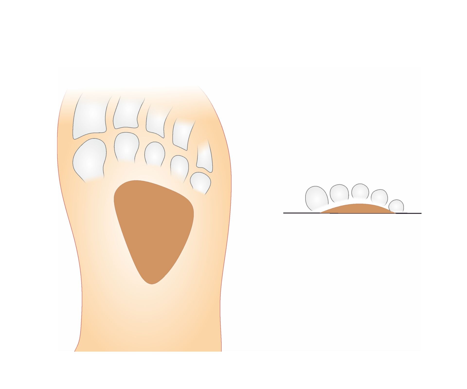 Grafika po lewej przedstawia schemat budowy stopy z trójkątną wkładką metatarsalną, która znajduje się pod kośćmi śródstopia.
Grafika po prawej przedstawia przekrój poprzeczny budowy stopy z trójkątną wkładką metatarsalną, która znajduje się pod kośćmi śródstopia.
