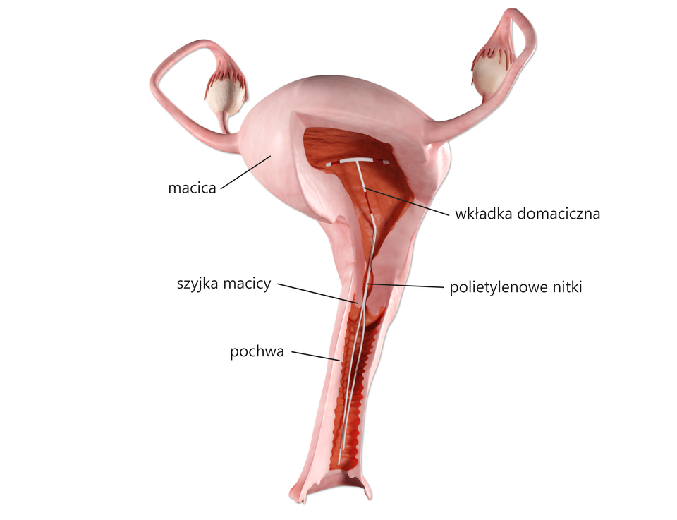 Ilustracja przedstawia narządy rodne kobiety wraz z umiejscowieniem wkładki domacicznej w macicy. Do wkładki przywiązane są polietylenowe nitki. Znajdują się w pochwie.   