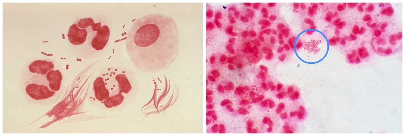 Ilustracja przedstawiająca wysięk z cewki moczowej zawierający bakterie dwoinki rzeżączki. Po lewej stronie, na żółtym tle, widoczne są czerwone, nieregularne okręgi i linie. Po prawej stronie, na białym tle, znajdują się ciemnoróżowe, drobne, nieregularne bakterie, pośród których kilka z nich zakreślona jest niebieskim okręgiem.