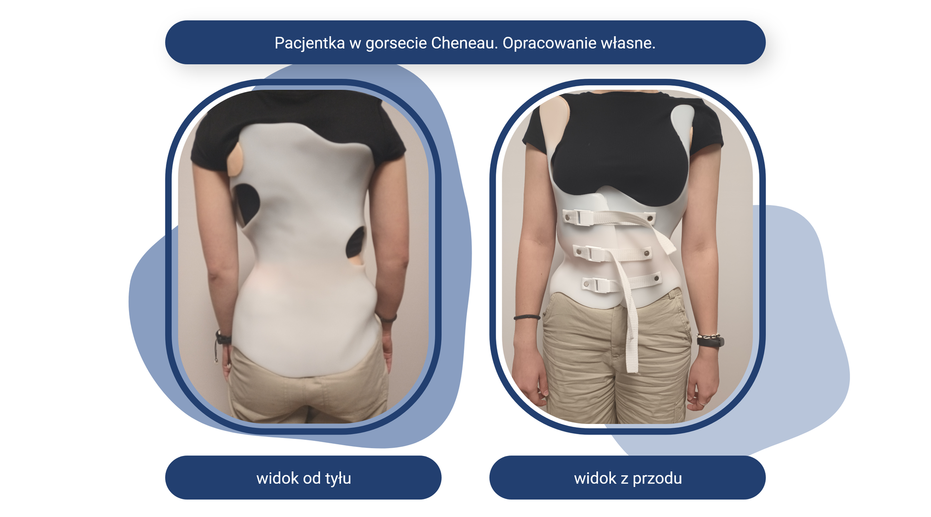 Plansza pod tytułem: Pacjentka w gorsecie Cheneau. Opracowanie własne. Plansza zawiera dwa zdjęcia.
Zdjęcie opisane jako widok od tyłu przedstawia stojącą tyłem pacjentkę w gorsecie wyprofilowanym odpowiednio do wady. Gorset sięga od kości miednicy do łopatek.
Zdjęcie opisane jako widok z przodu przedstawia stojącą przodem pacjentkę w gorsecie wyprofilowanym odpowiednio do wady. Gorset sięga od bioder do klatki piersiowej i ma swoje przedłużenie pod pachami, okalając klatkę piersiową. Gorset zapinany jest z przodu na trzy paski.
