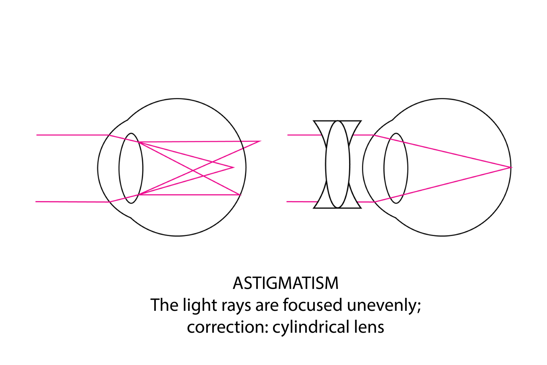 W galerii są rysunki, ilustrujące wady wzroku i sposoby ich korekcji. Oko z lewej dotknięte astygmatyzmem. Promienie świetlne skupiają się nierównomiernie. Korekcja przy pomocy soczewki cylindrycznej.