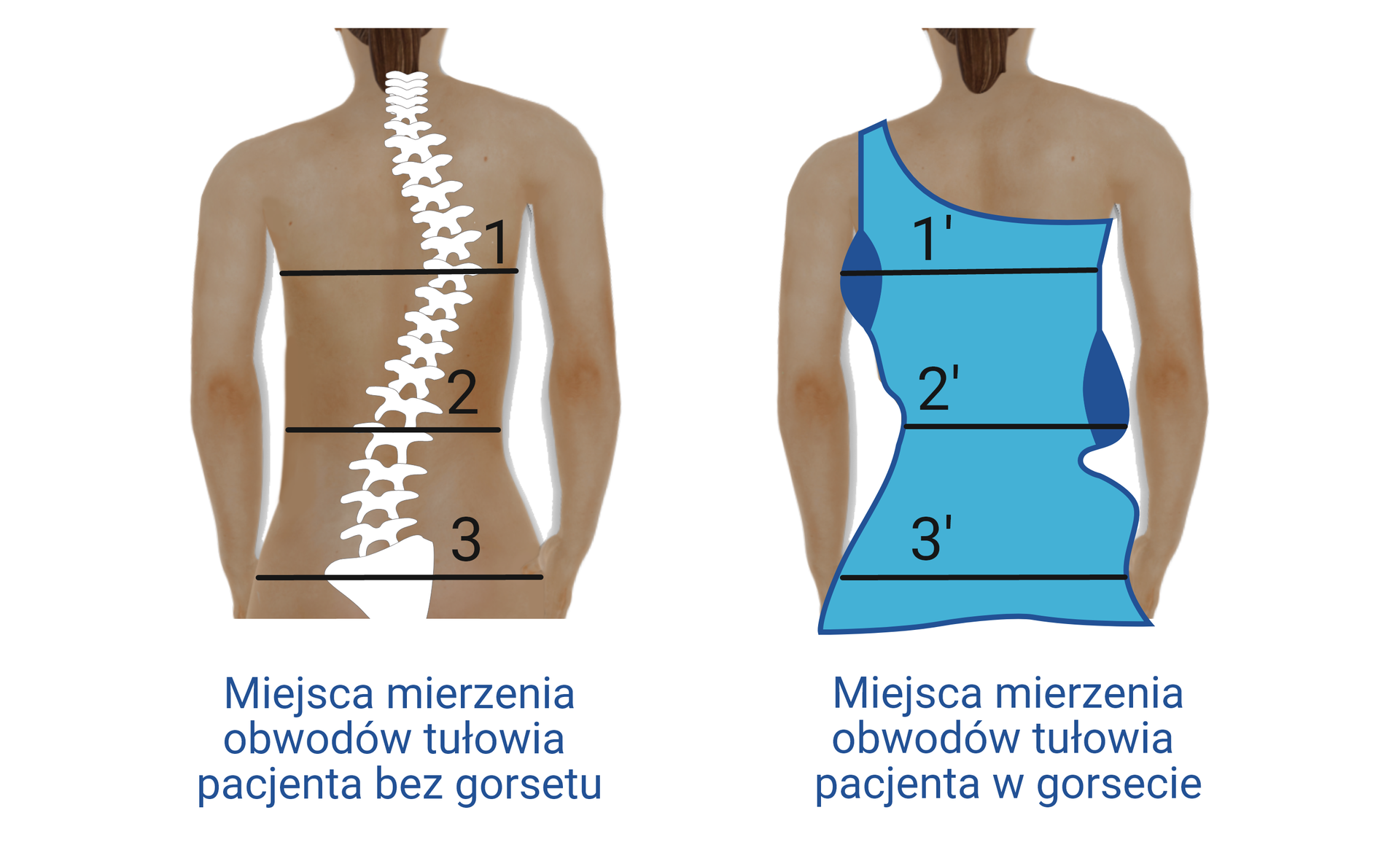 Grafika przedstawiająca ciało pacjenta. Na rycinie zaznaczono miejsca mierzenia tułowia pacjenta bez gorsetu i w gorsecie. W obu przypadkach pomiarów dokonuje się pod pachami, w talii oraz na wysokości bioder pacjenta. 
