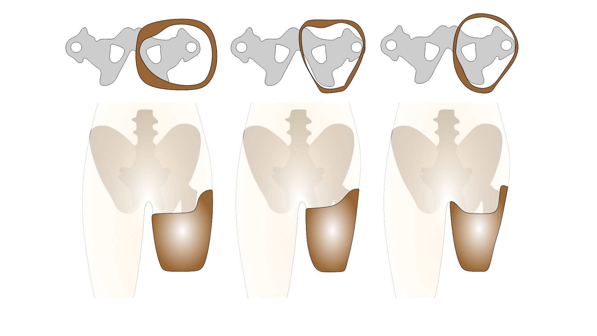 Grafika przedstawia leje obejmujące kikut lewej kończyny pacjenta, która została amputowana na wysokości stawu biodrowego. Zaprezentowano widok z góry i z boku. Przedstawione typy lejów to, od lewej: lej czworoboczny, lej MAS i lej IRC. Lej czworoboczny zarówno z góry, jak i z boku ma regularny, niemal prostokątny kształt, z przedłużeniem po stronie bocznej w rejonie panewki stawu biodrowego. Lej MAS jest zwężony ku dołowi, co zostało zaprezentowane w widoku bocznym. Widok z góry pokazuje, że lej ten ma kształt trójkątny. Lej IRC jest najbardziej zwężony ku dołowi, z najdłuższym przedłużeniem w rejonie panewki stawu biodrowego, co pokazuje ujęcie z boku. Z góry zaś widać, że lej IRC ma owalny, nieregularny kształt. 
