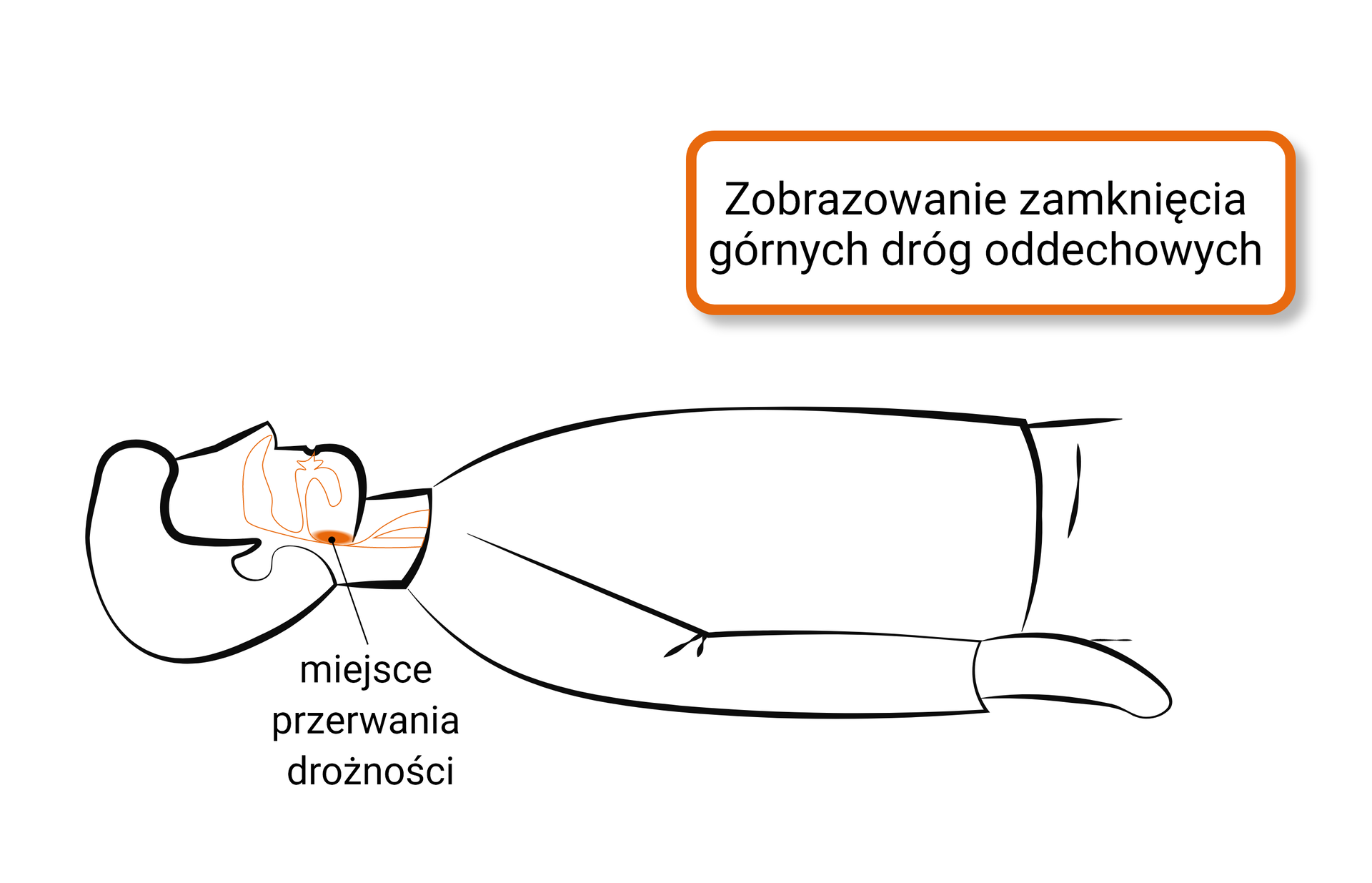 Na ekranie zobrazowanie zamknięcia górnych dróg oddechowych z zaznaczonym miejscem przerwania drożności w gardle.